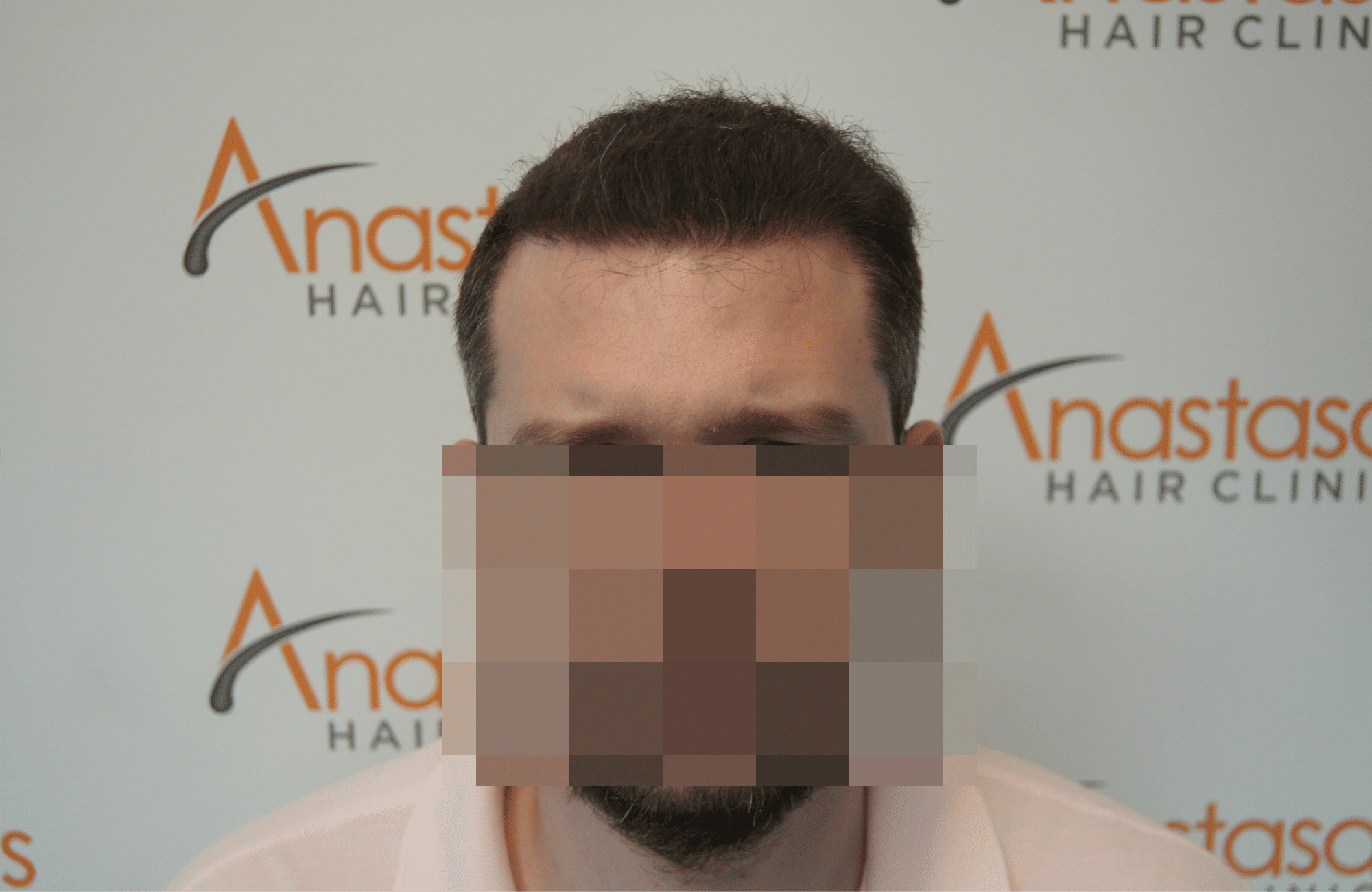 hair transplant patient result with 3500 fus after - fullface