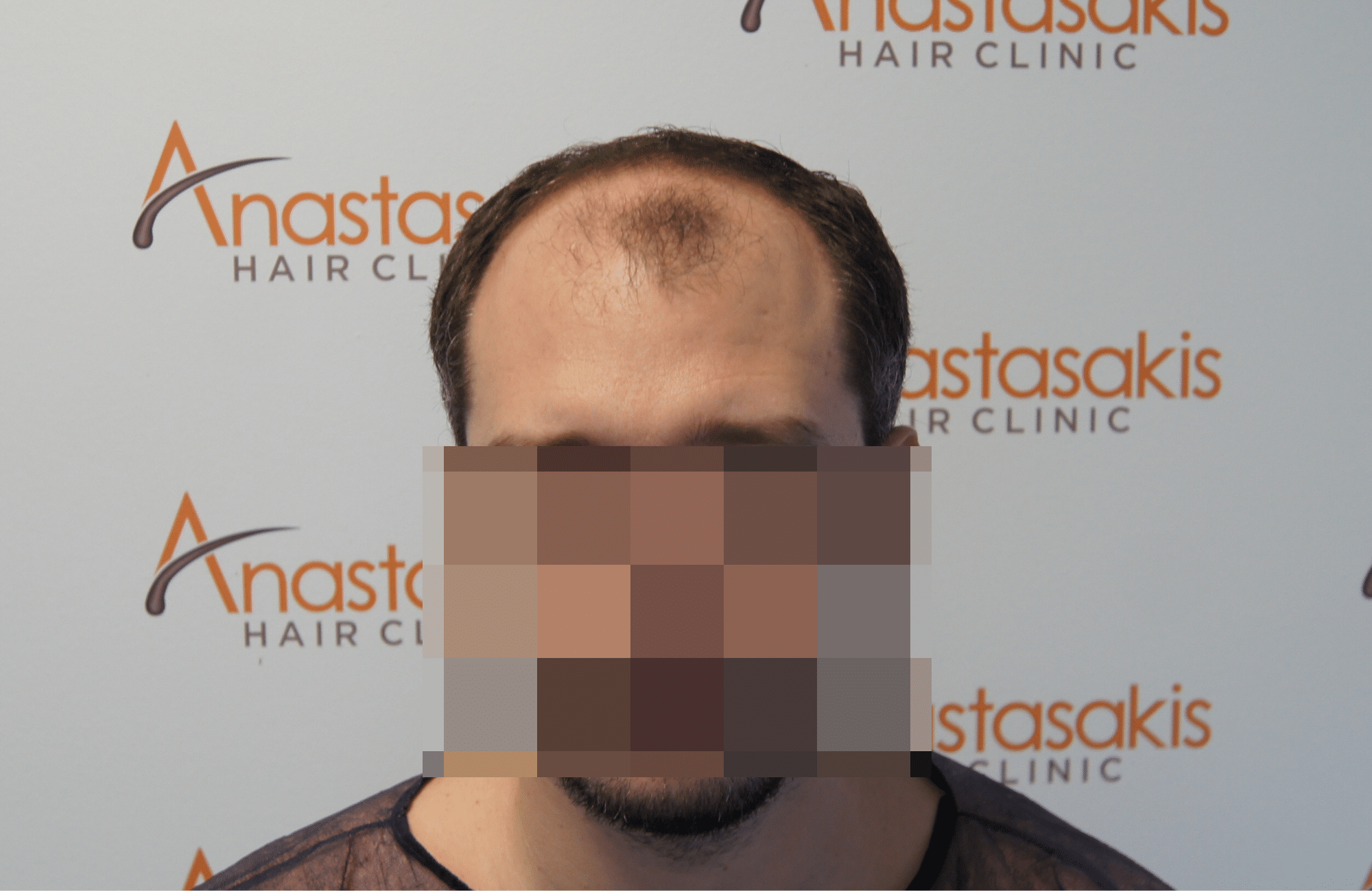 hair transplant patient result with 3500 fus before - fullface