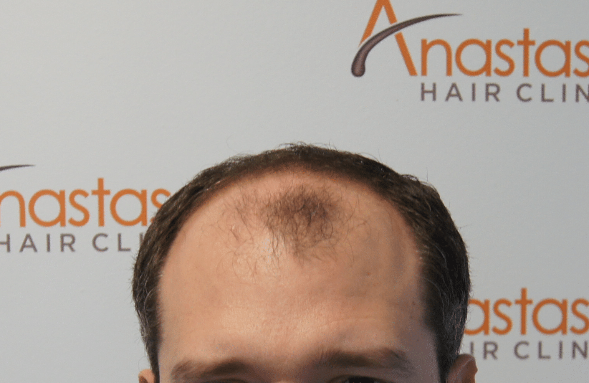hair transplant patient result with 3500 fus before - hairline