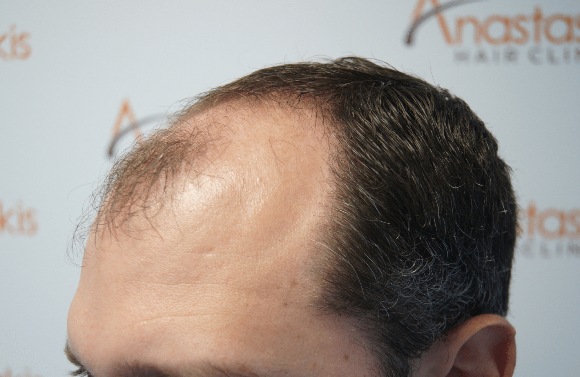 hair transplant patient result with 3500 fus before - side2