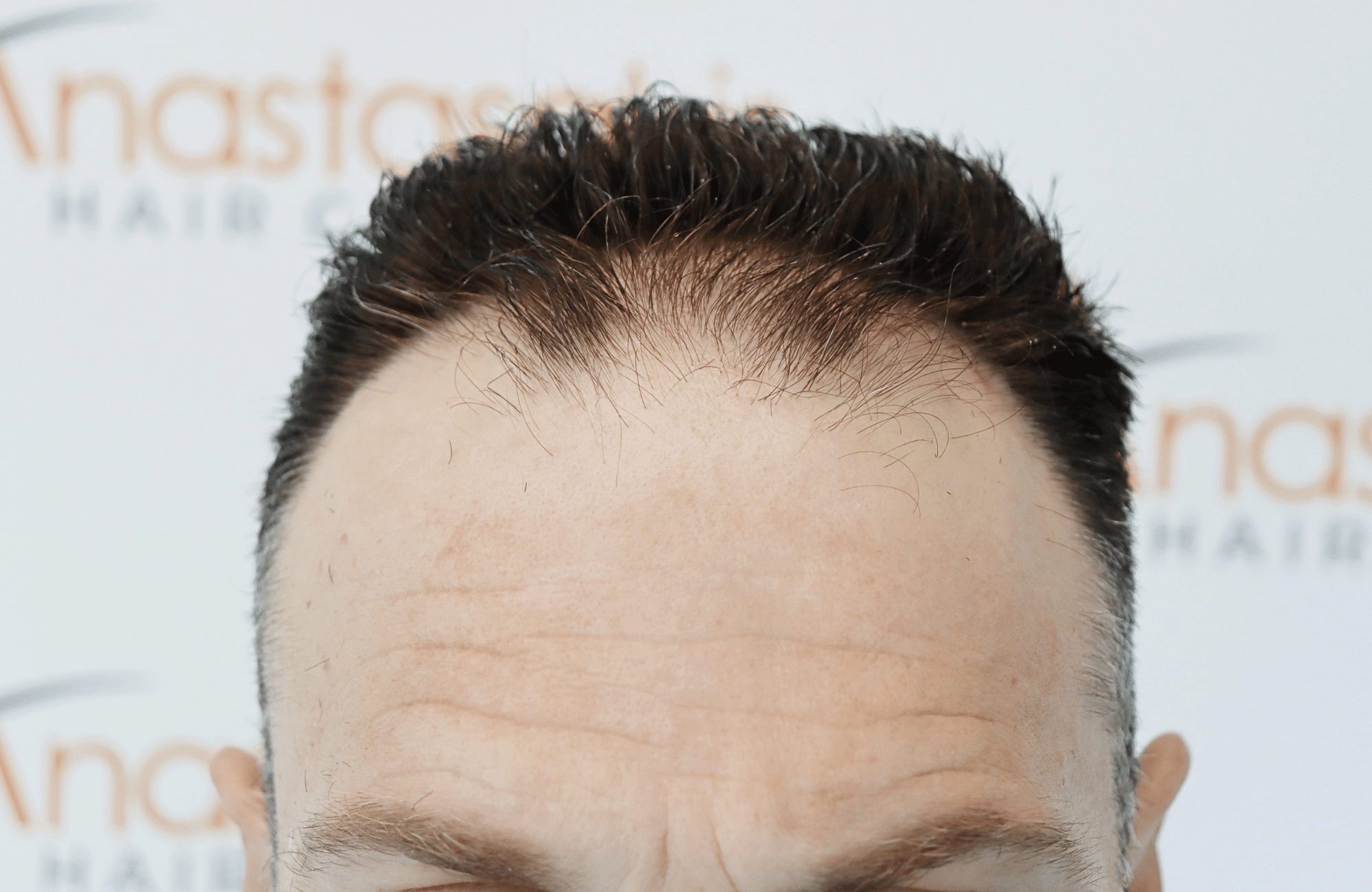 hair transplant resilt 2500 fus wavy frontal thick