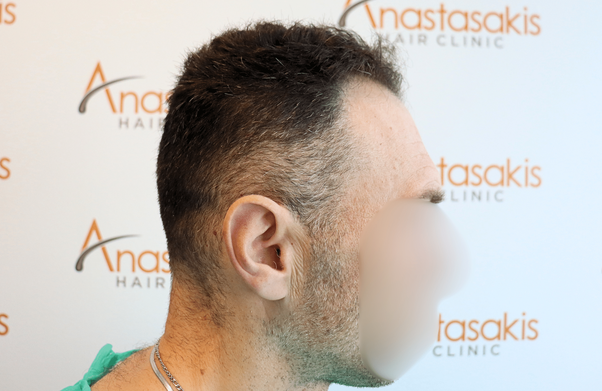 hair transplant resilt 2500 fus wavy frontal thick