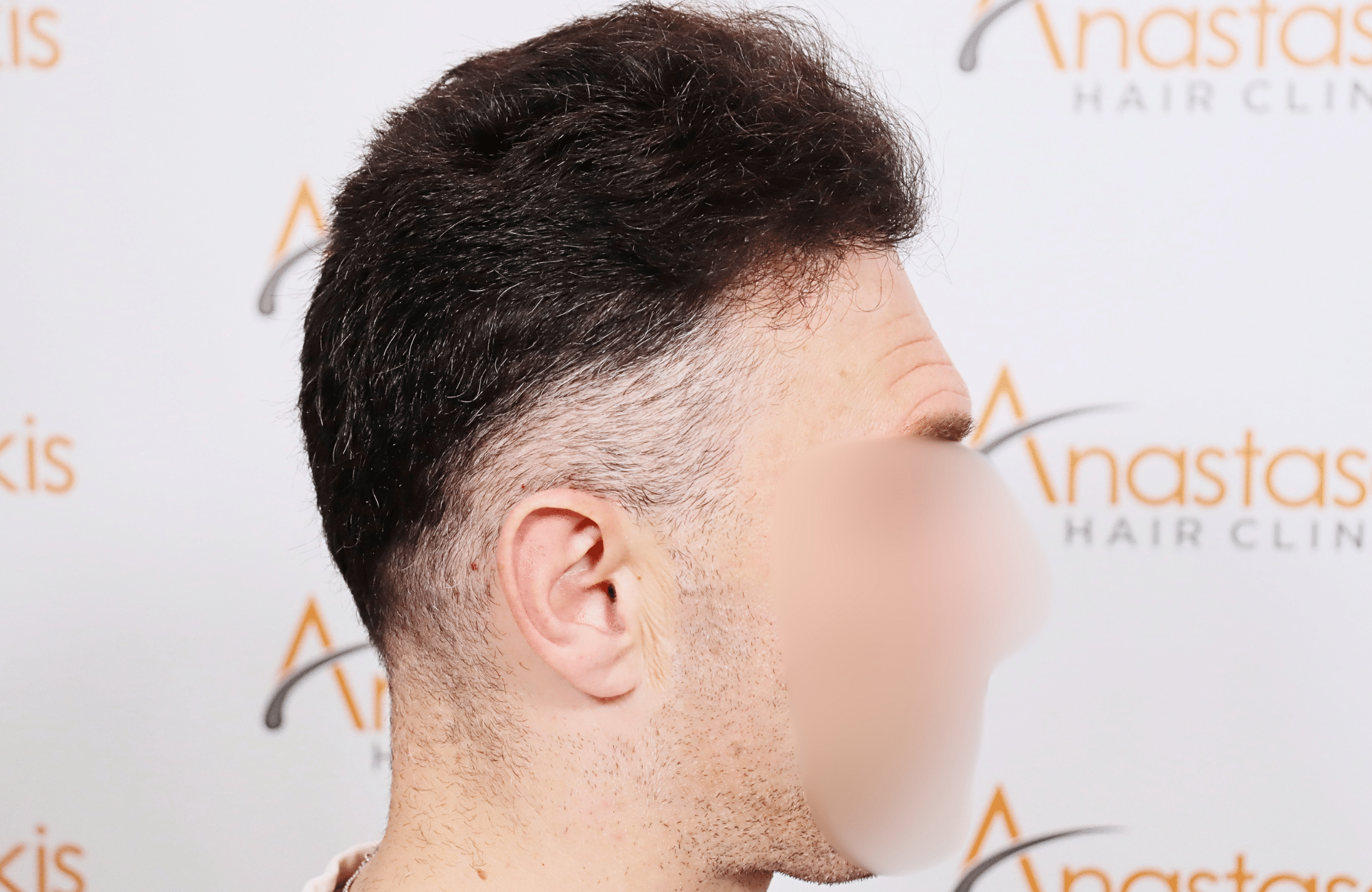 hair transplant resilt 2500 fus wavy frontal thick