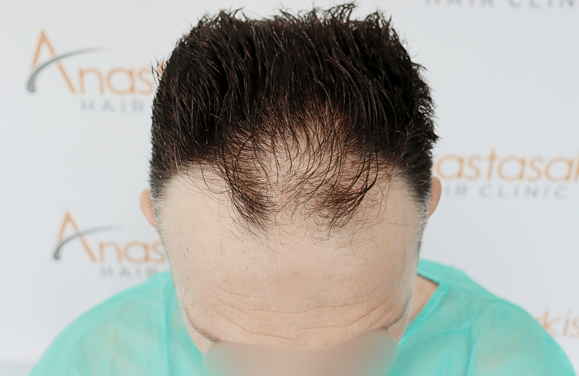 hair transplant resilt 2500 fus wavy frontal thick