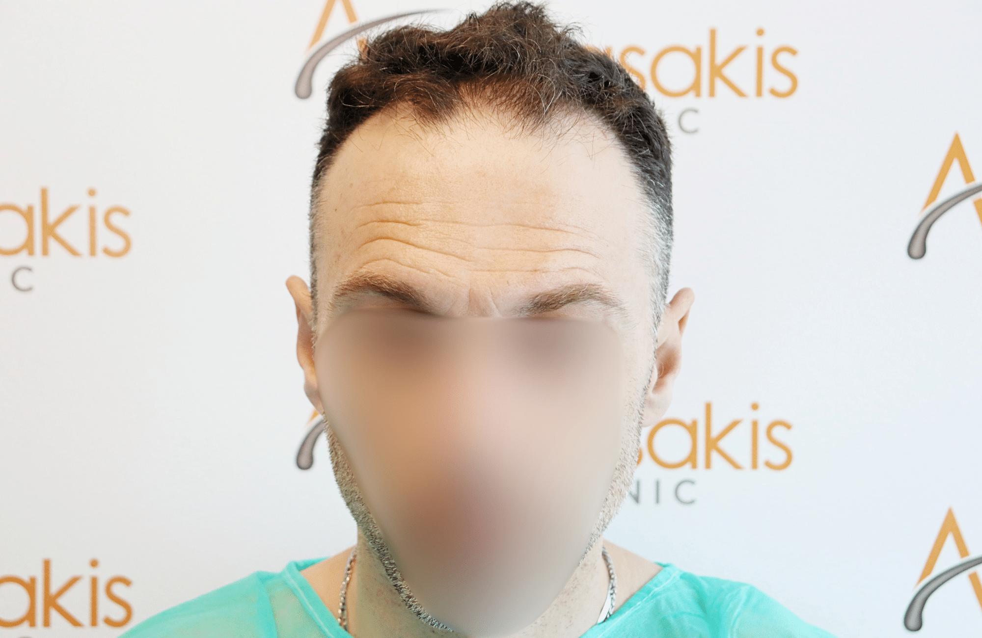 hair transplant resilt 2500 fus wavy frontal thick