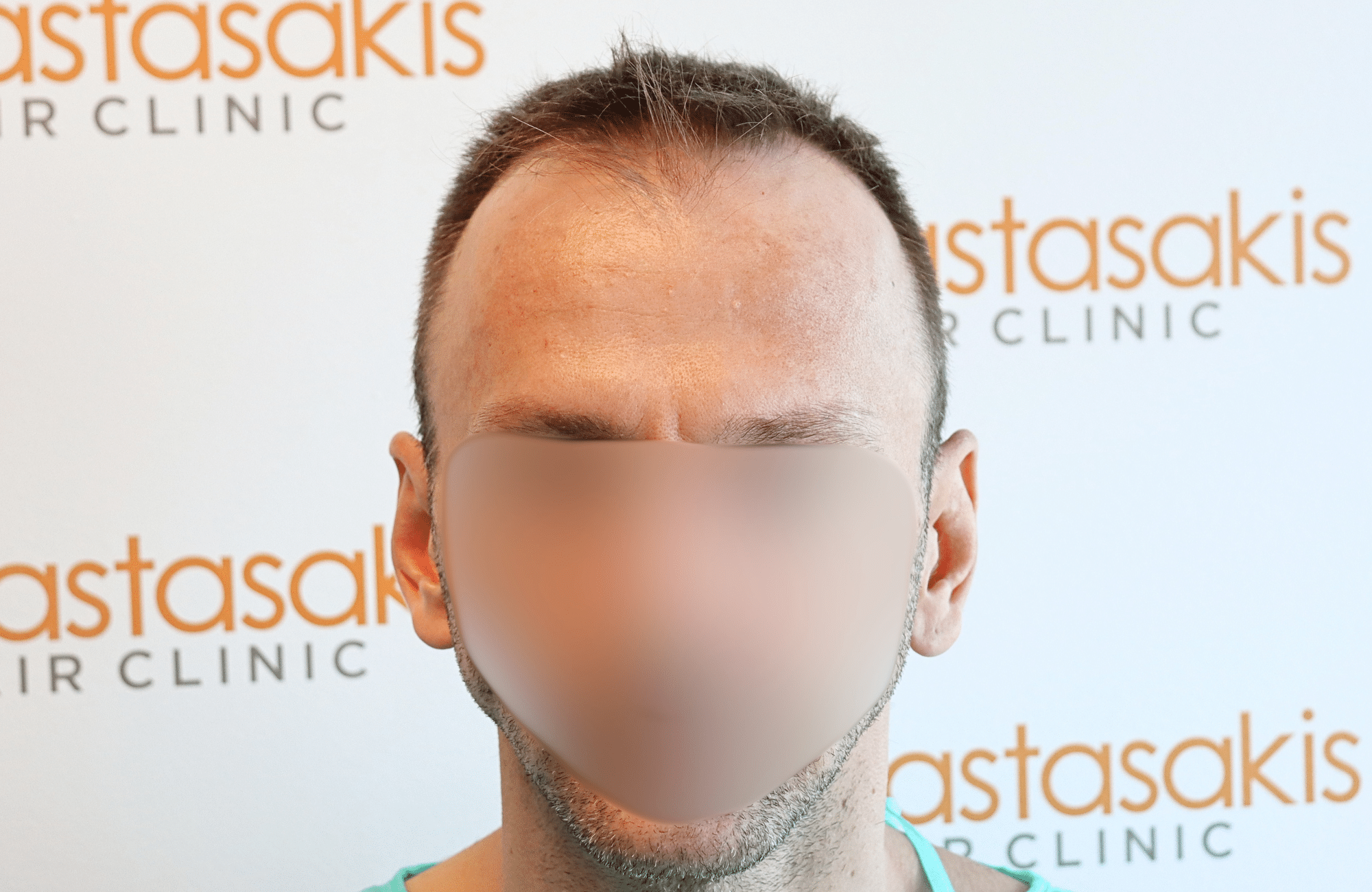 hair transplant resukt with 2600 fus triangular