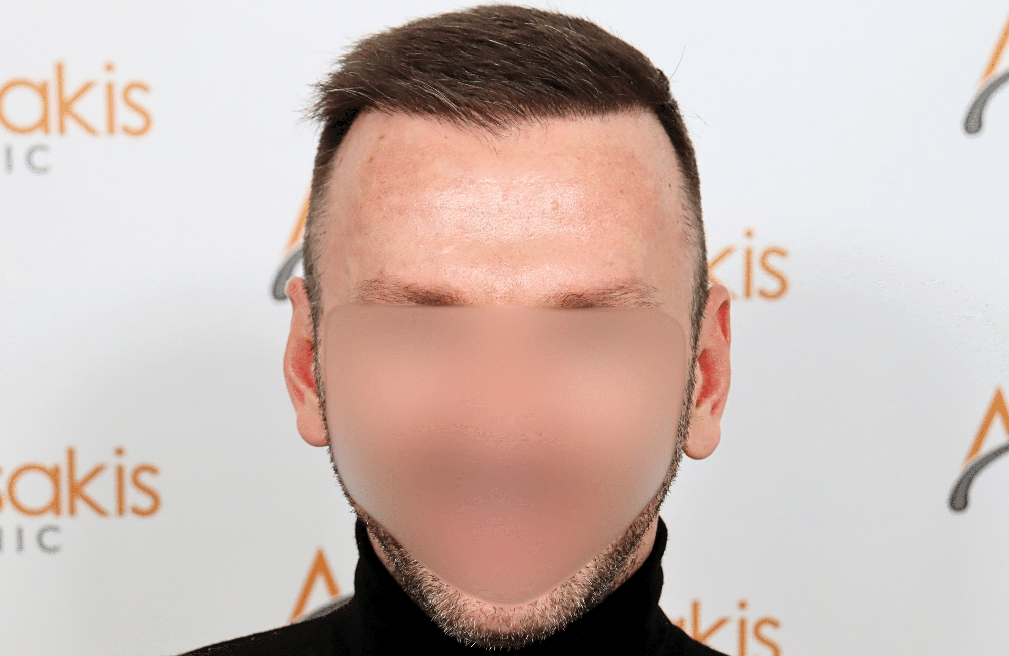 hair transplant resukt with 2600 fus triangular
