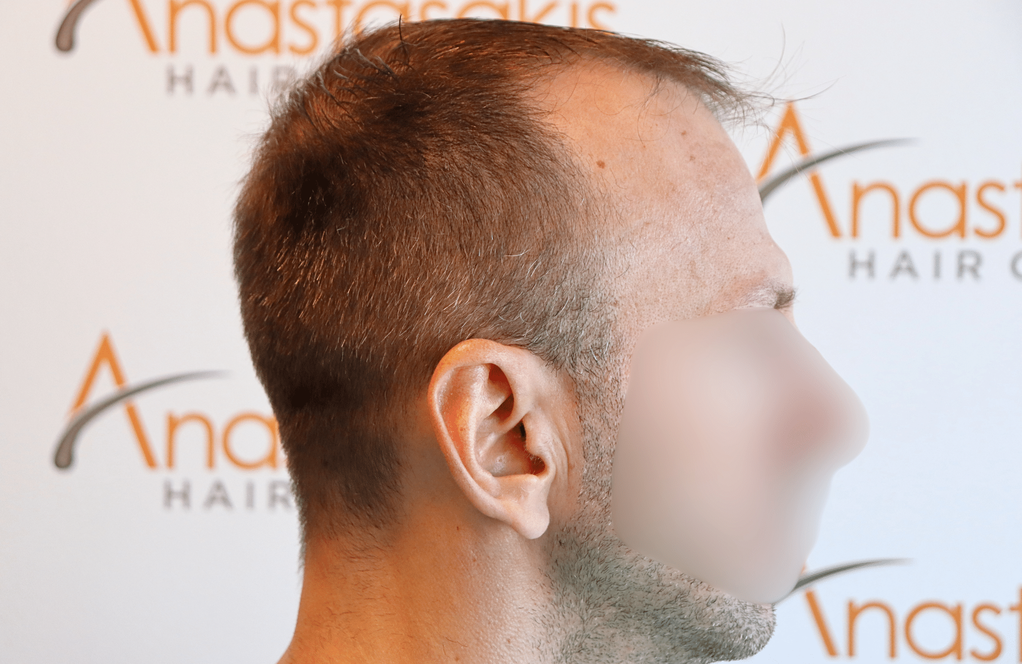 hair transplant resukt with 2600 fus triangular