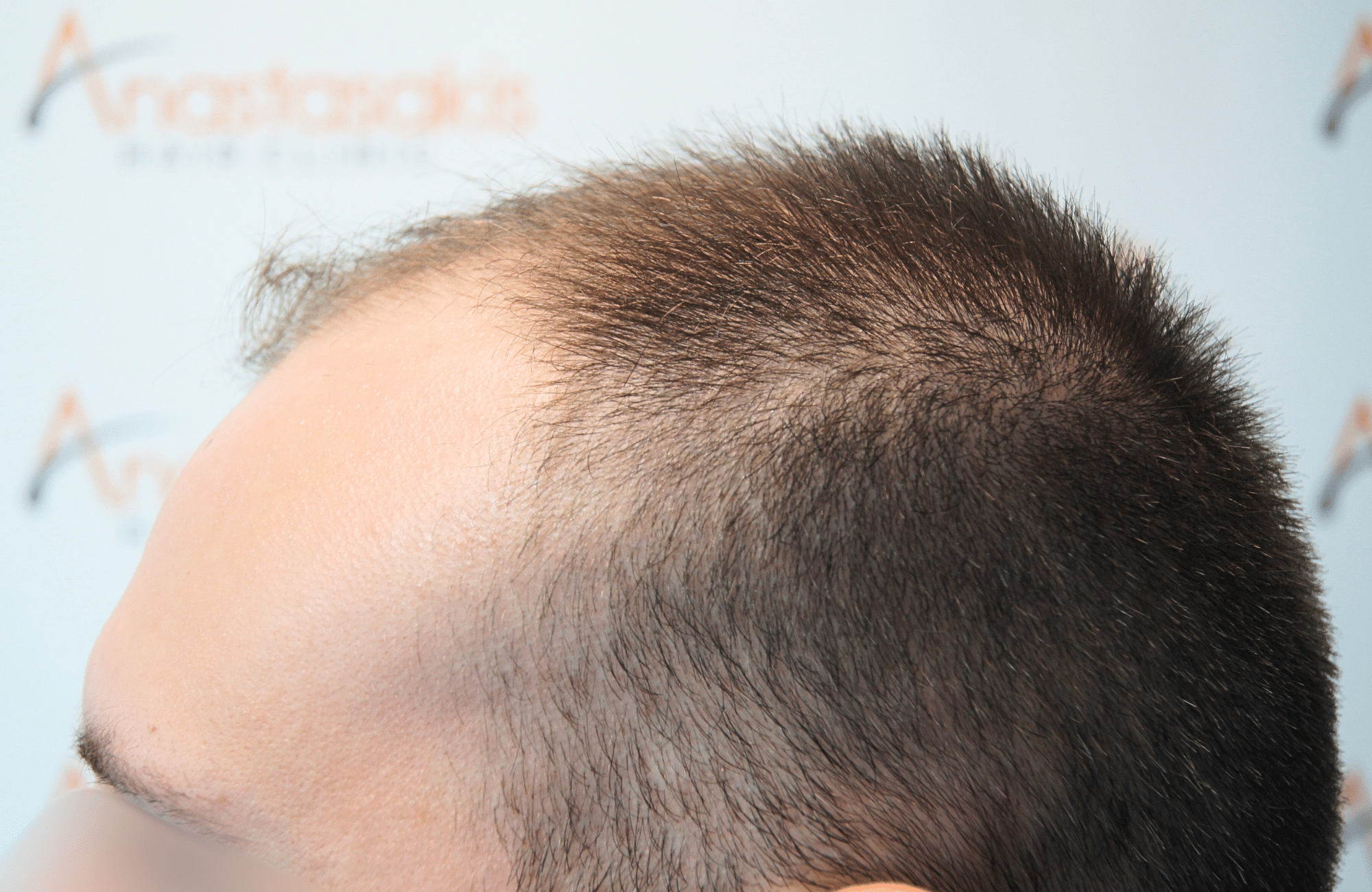hair transplant result 1800 fus stage 5 frontal