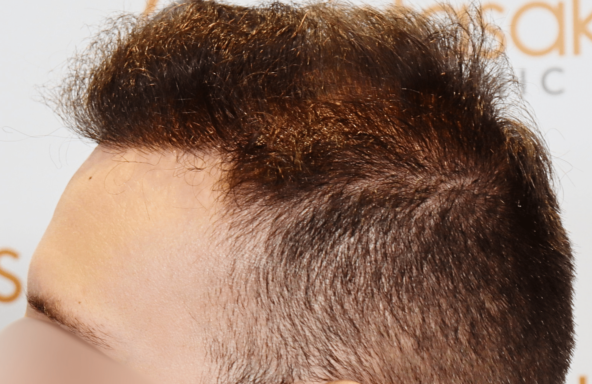 hair transplant result 1800 fus stage 5 frontal