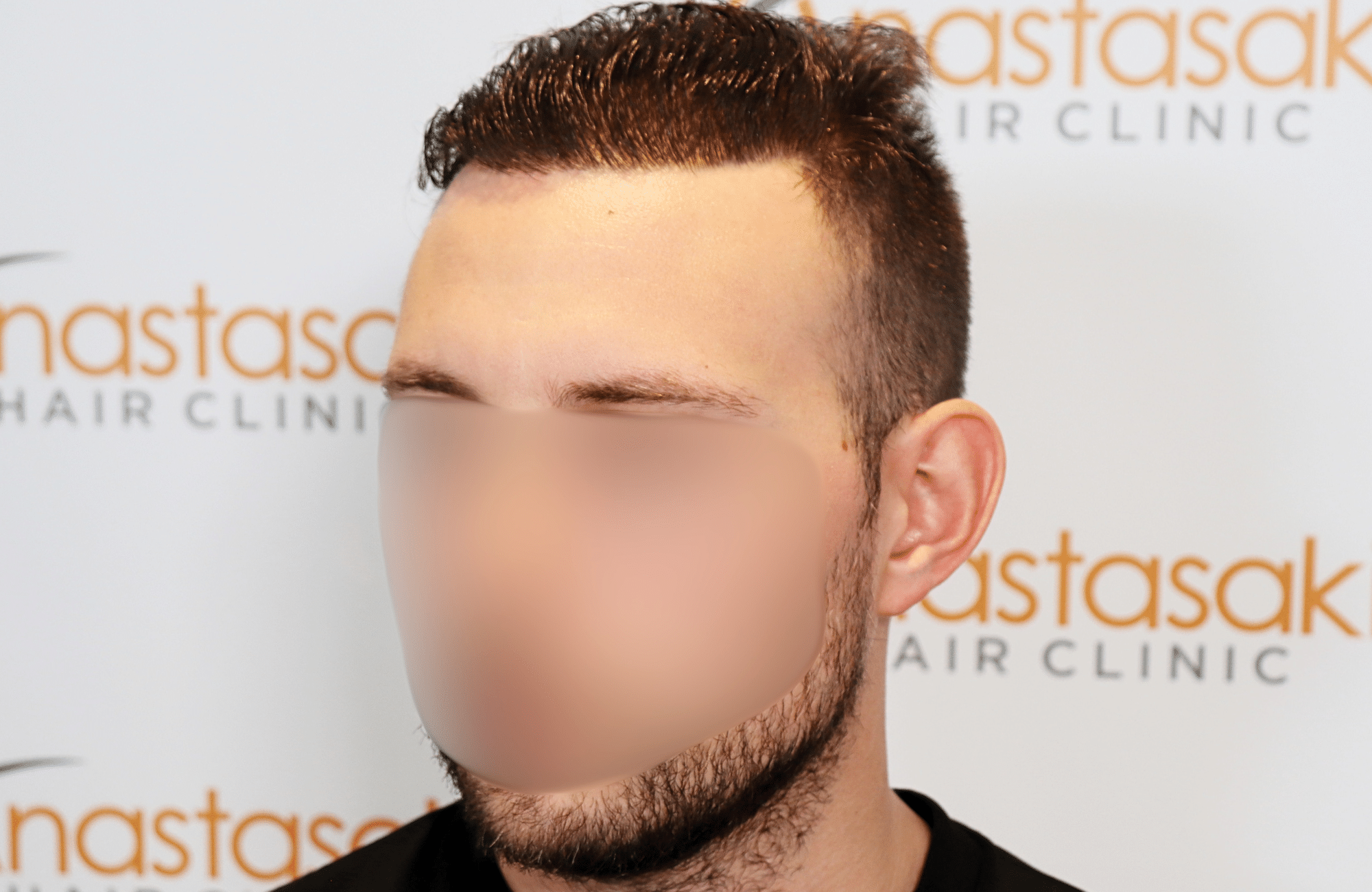 hair transplant result 1800 fus stage 5 frontal