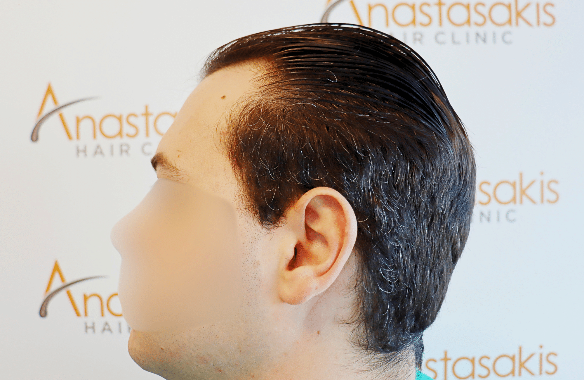 hair transplant result 1800 fus temples thick (2)
