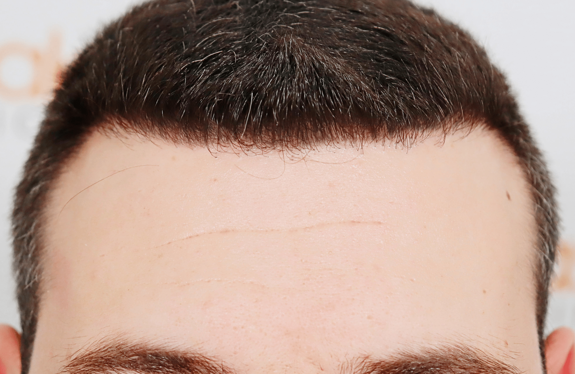 hair transplant result 1800 fus temples thick (5)