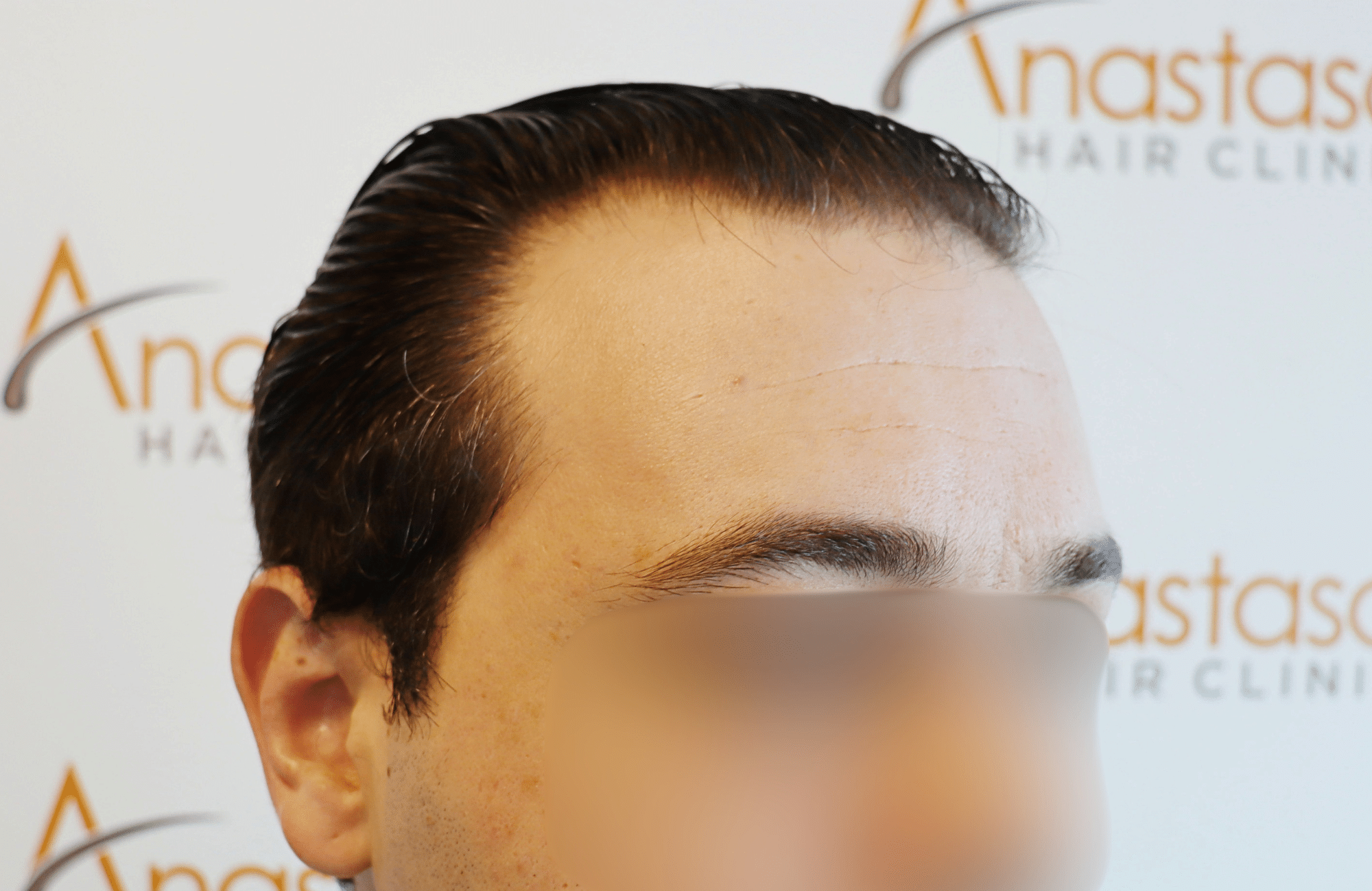 hair transplant result 1800 fus temples thick (9)