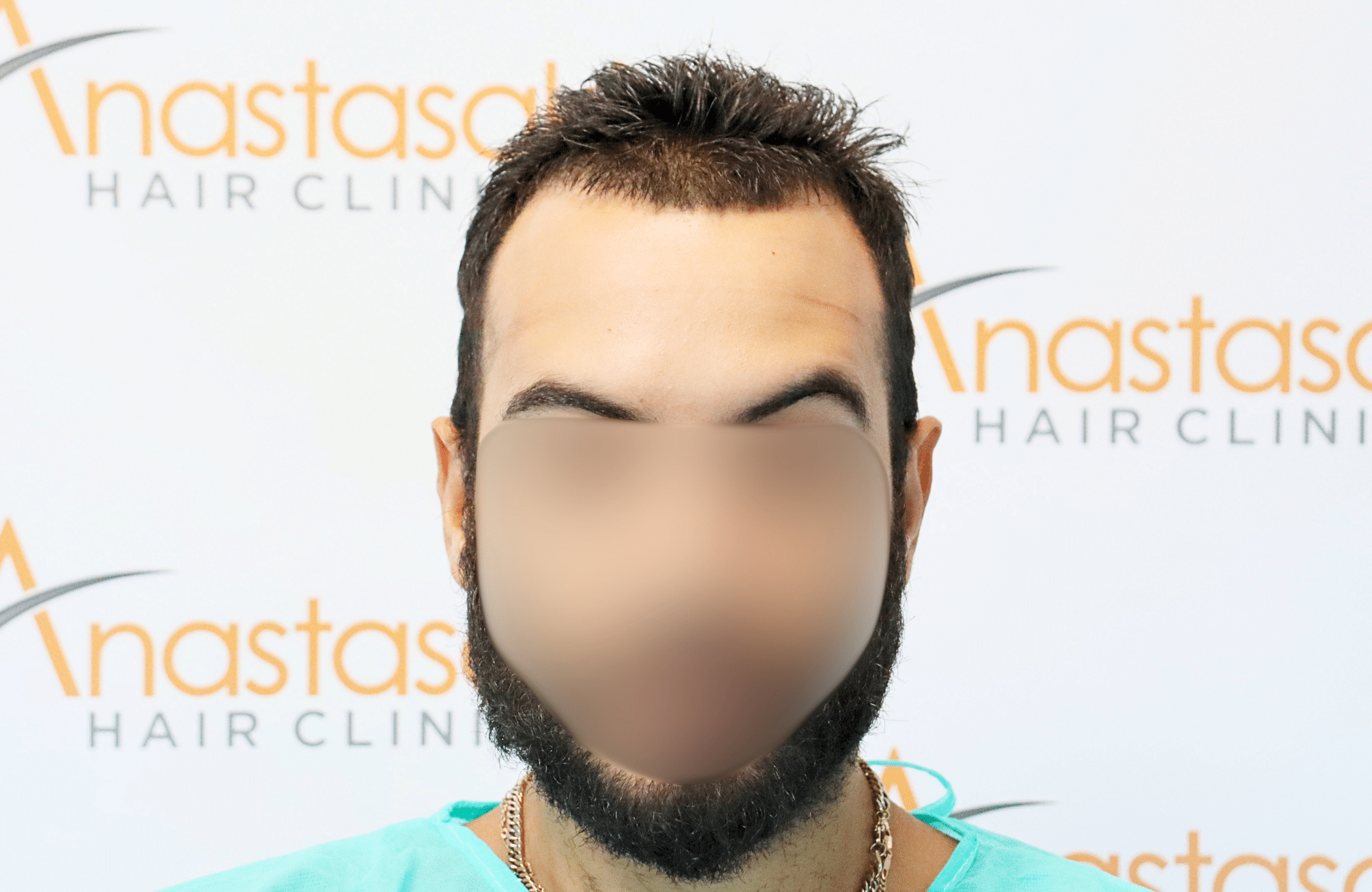 hair transplant result 2000 fus thick frontal
