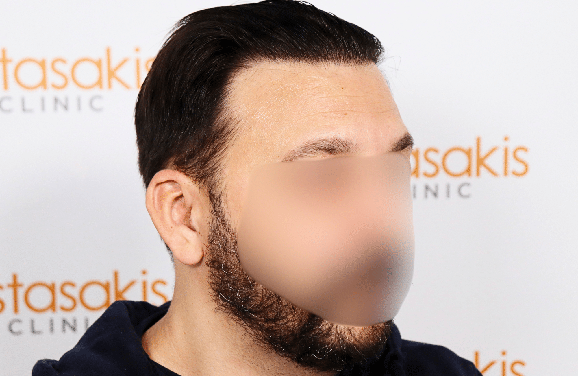hair transplant result 2000 fus stage 4 crown thick