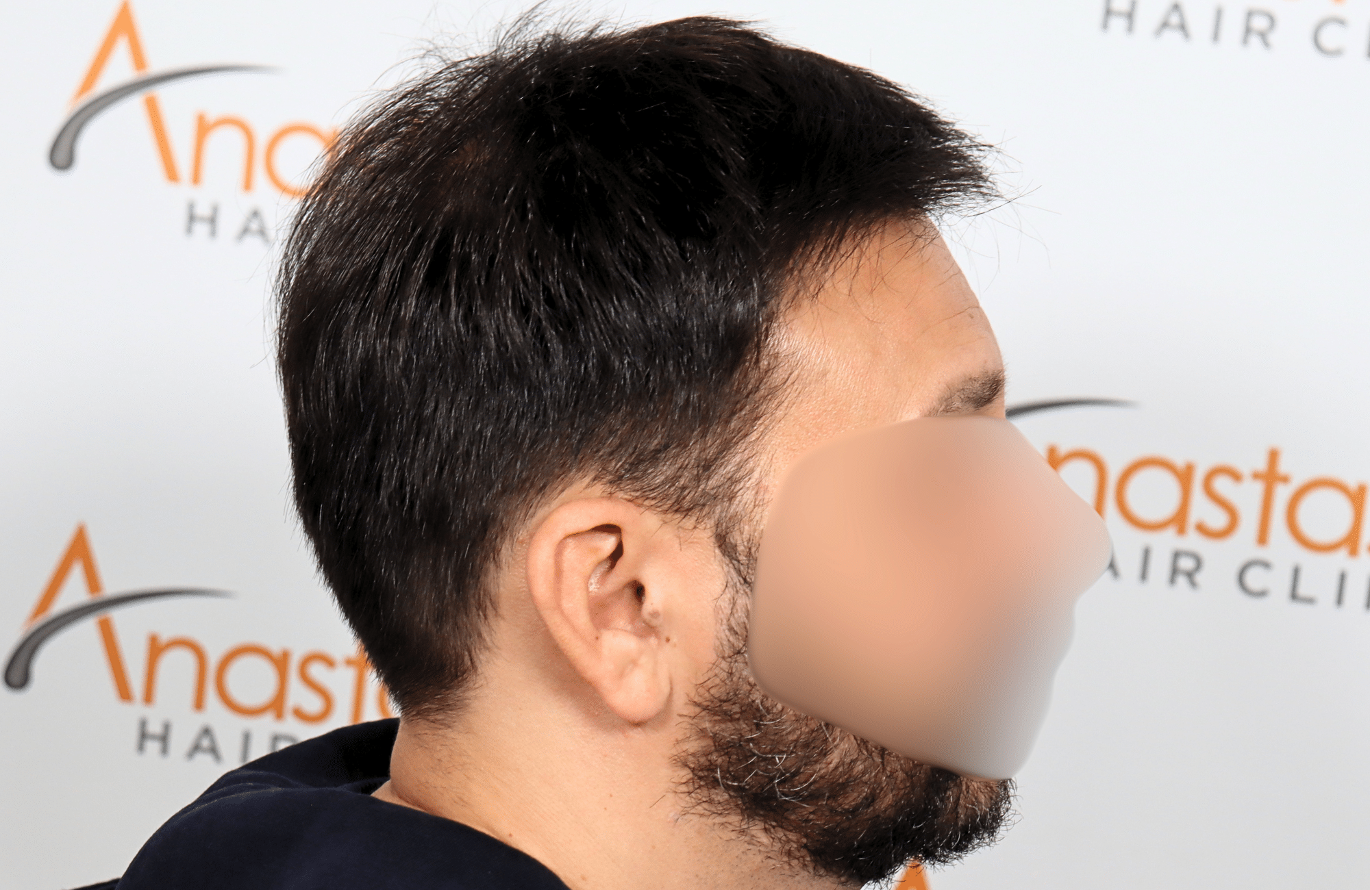 hair transplant result 2000 fus stage 4 crown thick