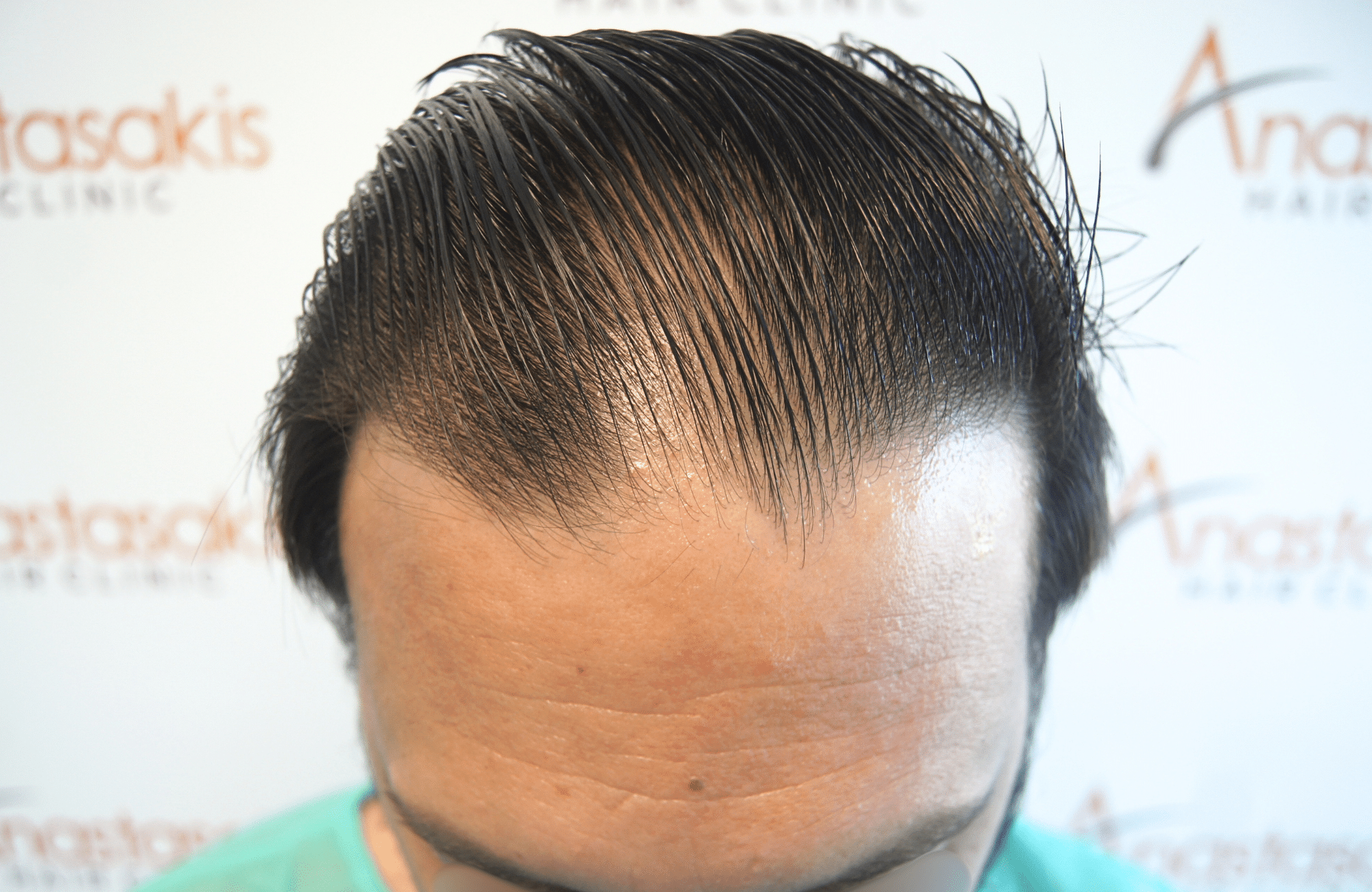 hair transplant result 2000 fus stage 4 crown thick