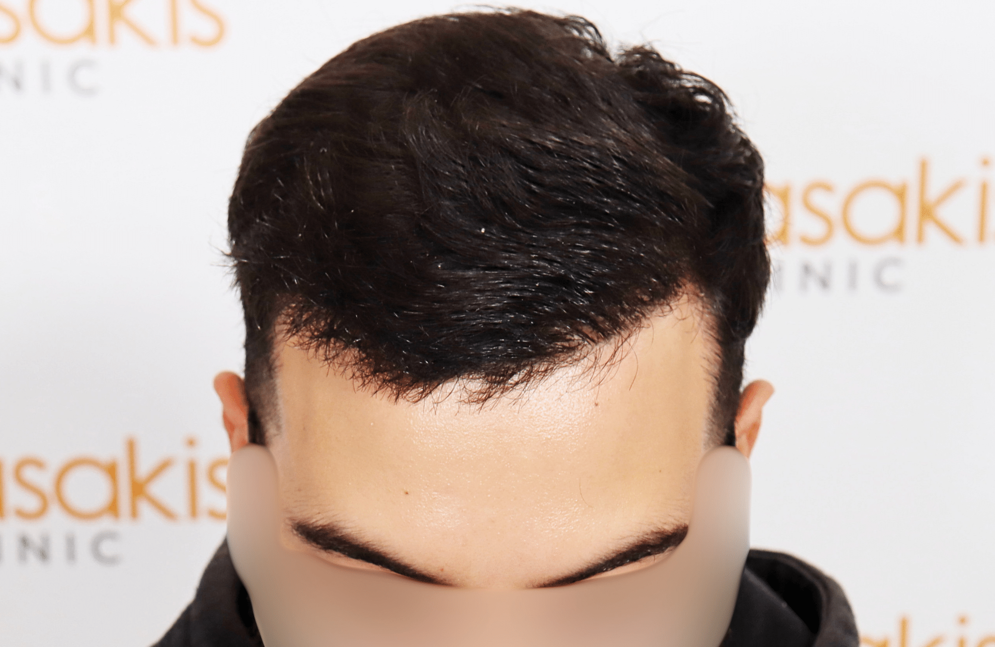 hair transplant result 2000 fus thick frontal
