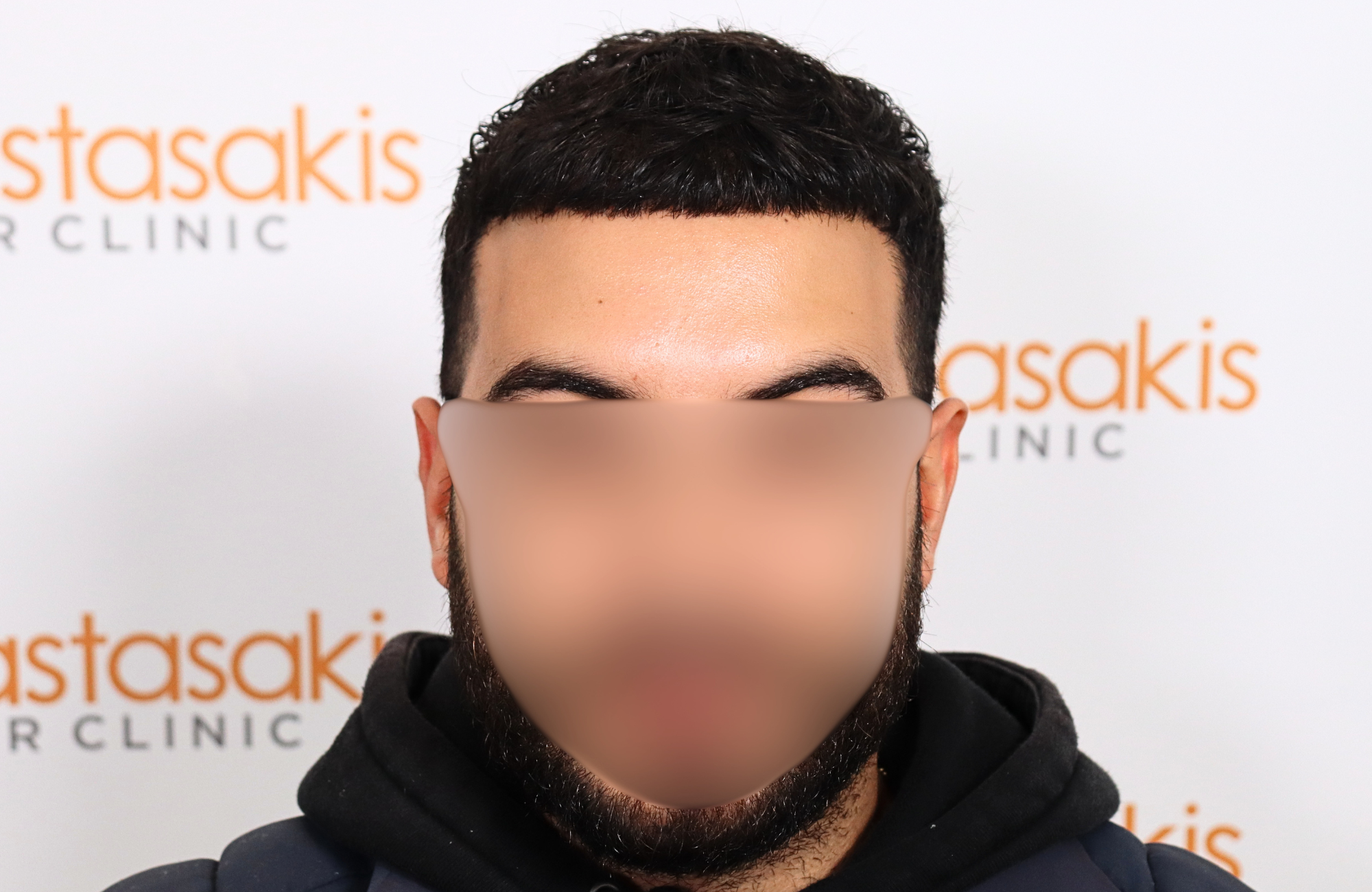 hair transplant result 2000 fus thick frontal