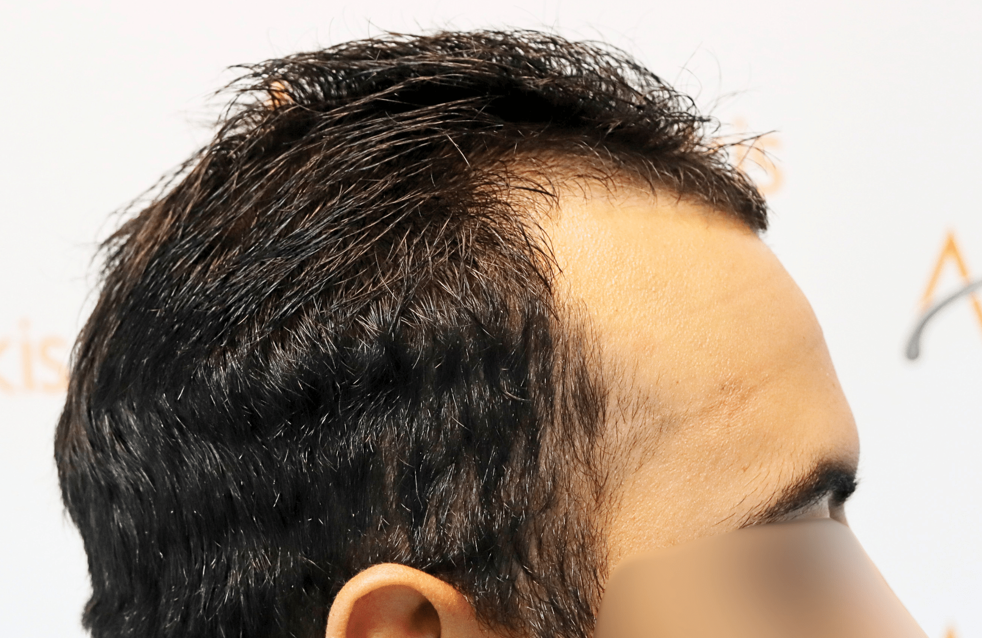 hair transplant result 2000 fus thick frontal