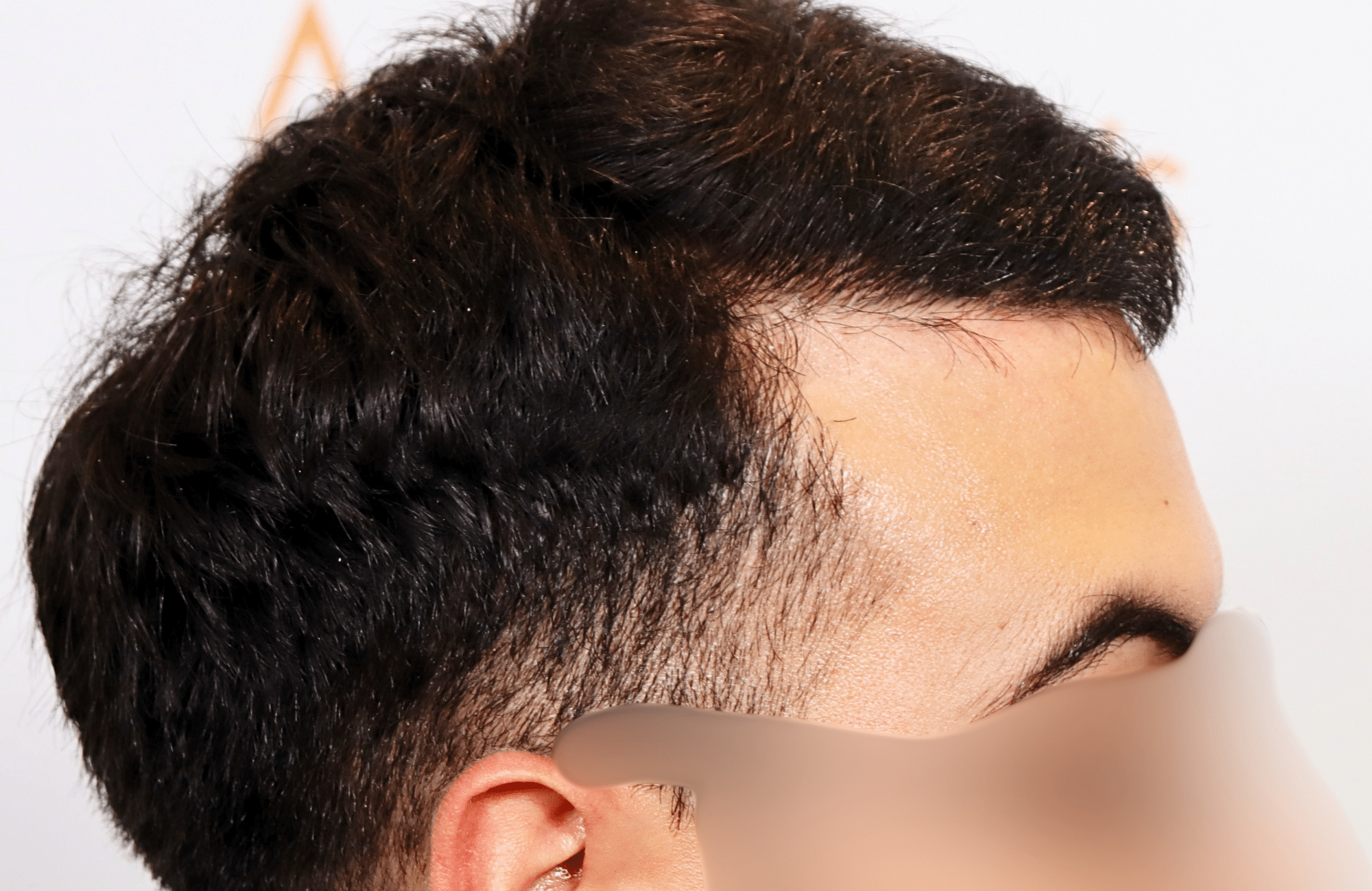 hair transplant result 2000 fus thick frontal