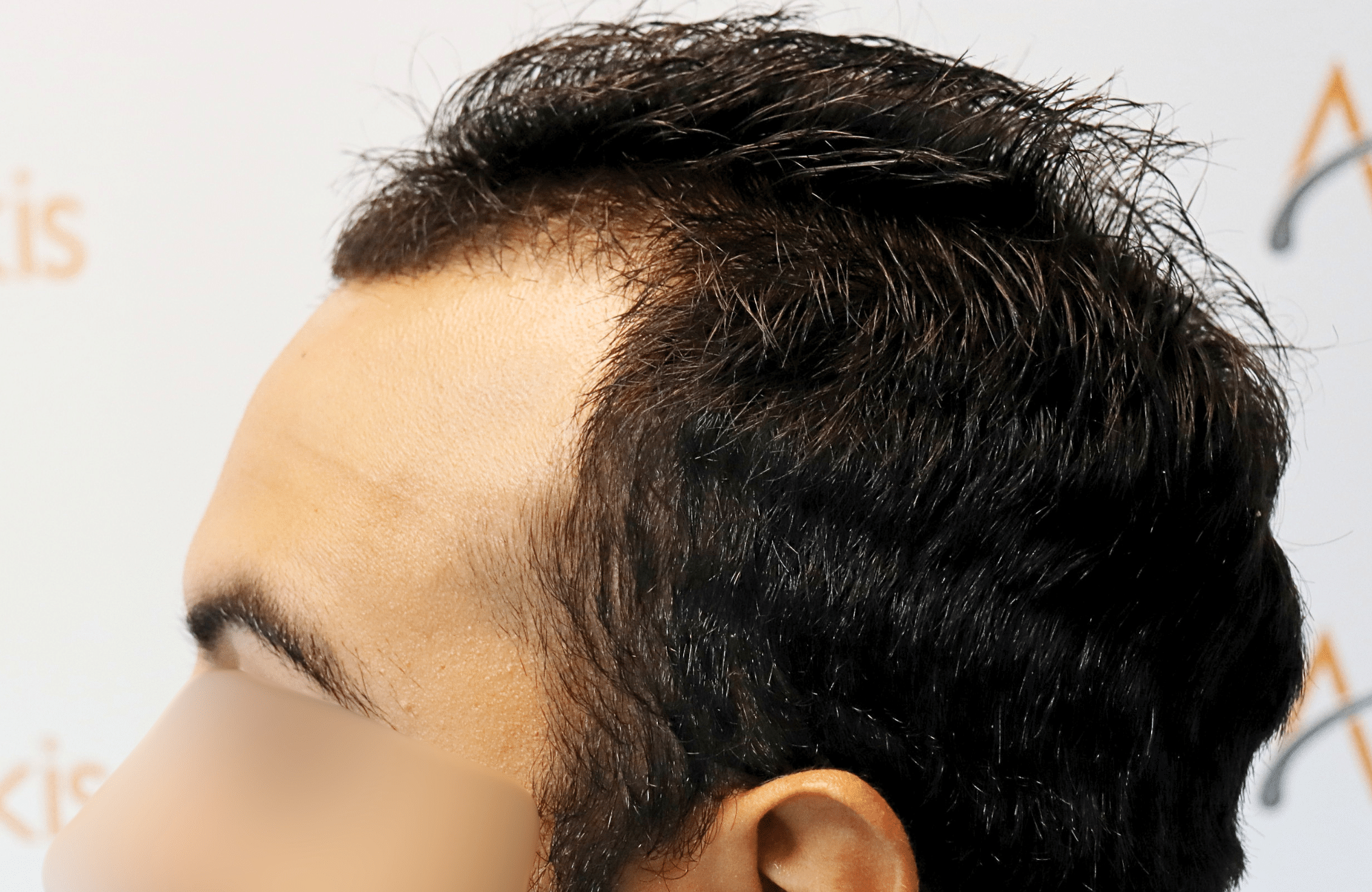 hair transplant result 2000 fus thick frontal