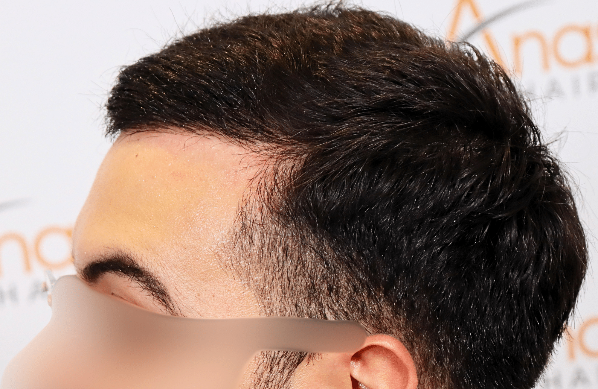 hair transplant result 2000 fus thick frontal