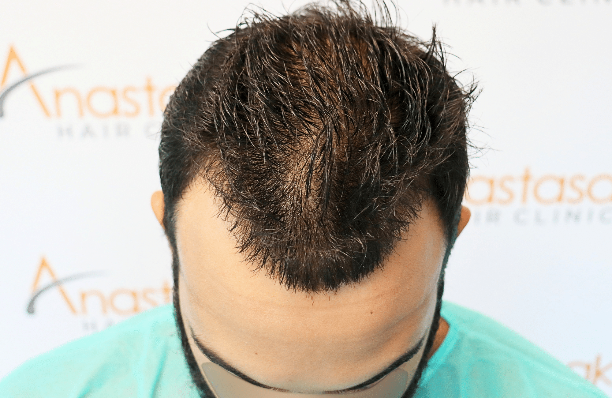 hair transplant result 2000 fus thick frontal