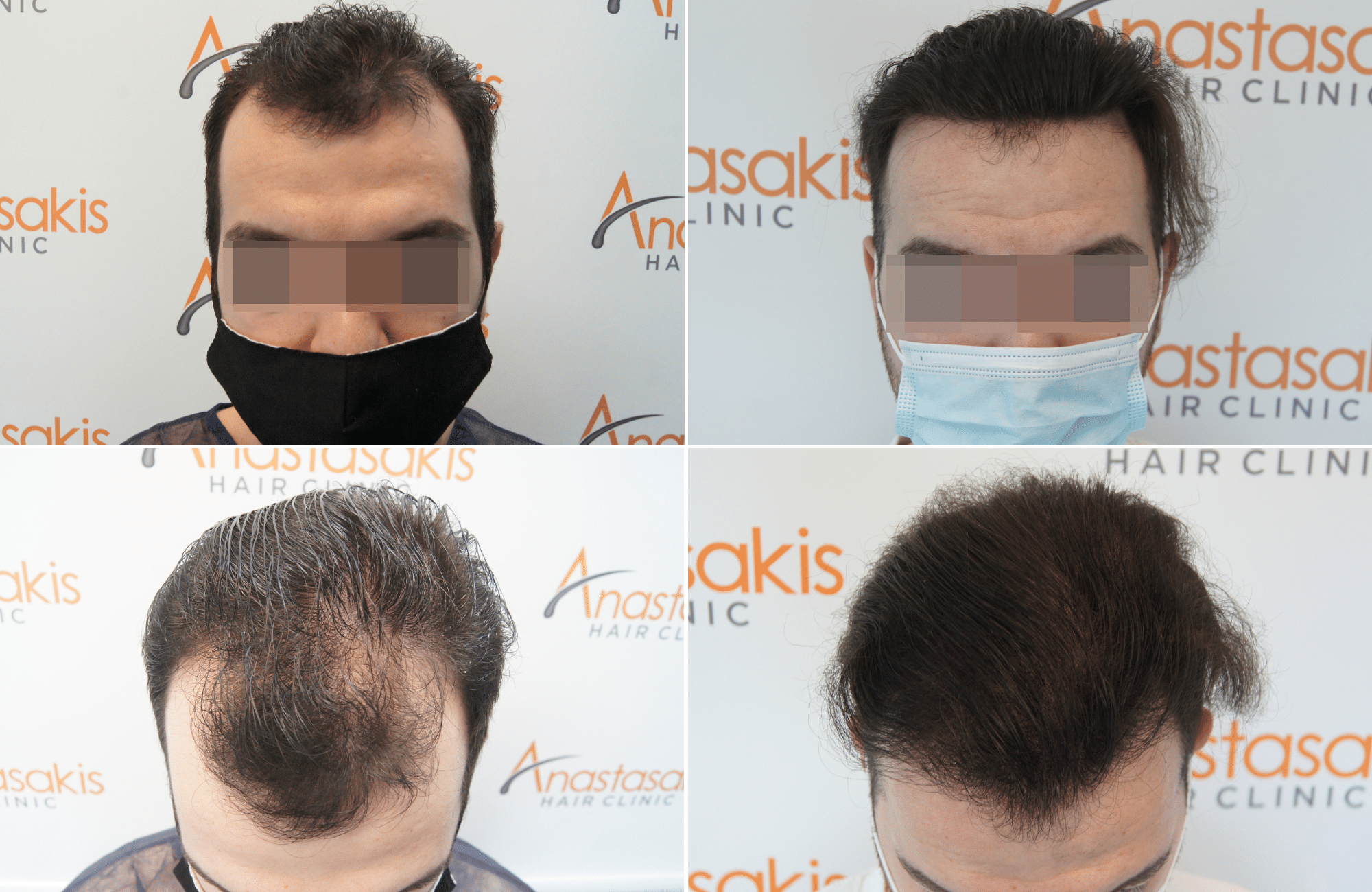 https://anastasakishairclinic.com/portfolio/apotelesma-metamosxefsis-mallion-anastasakis-hair-clinic-32/