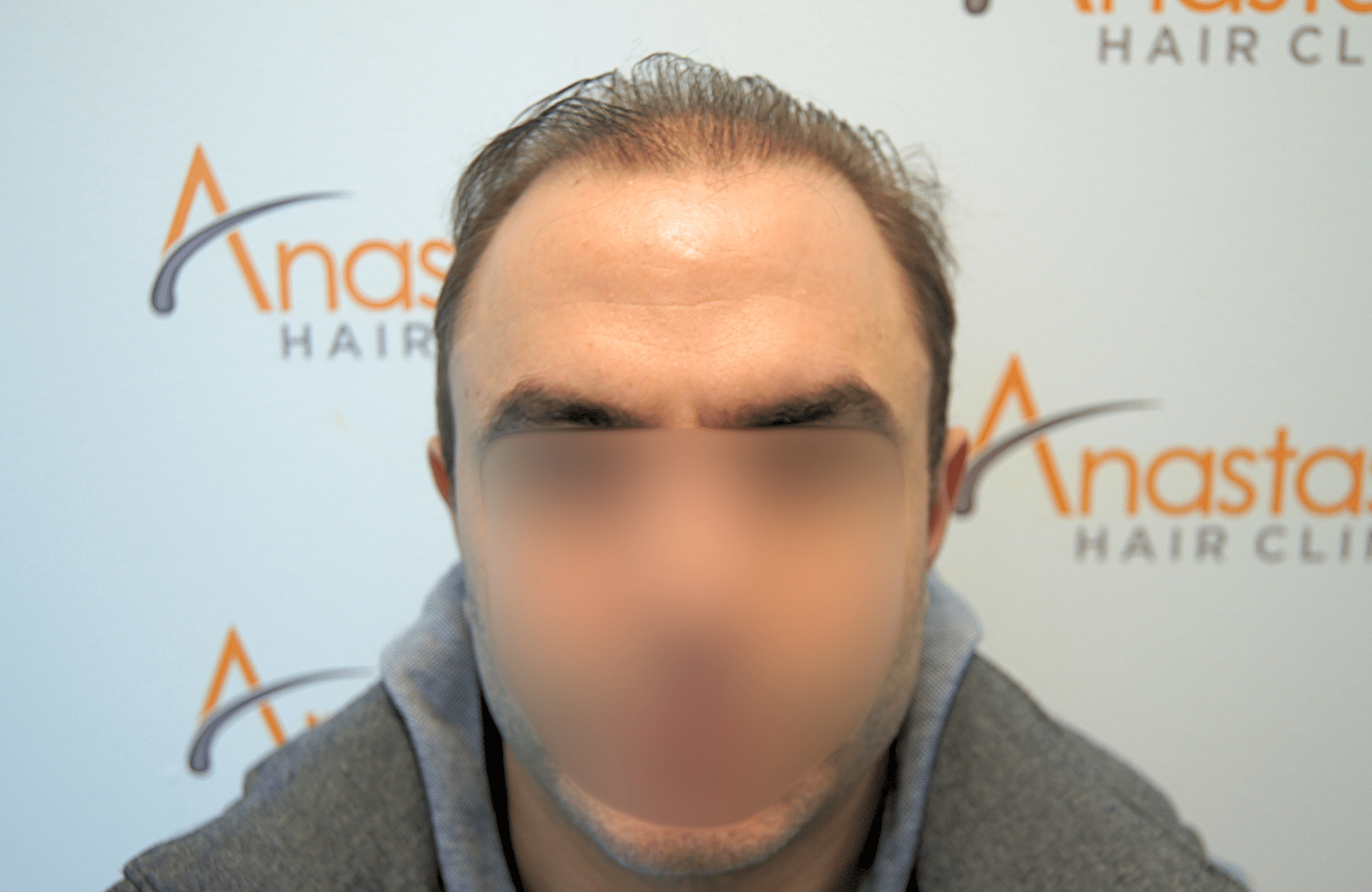 hair transplant result 5200 fus