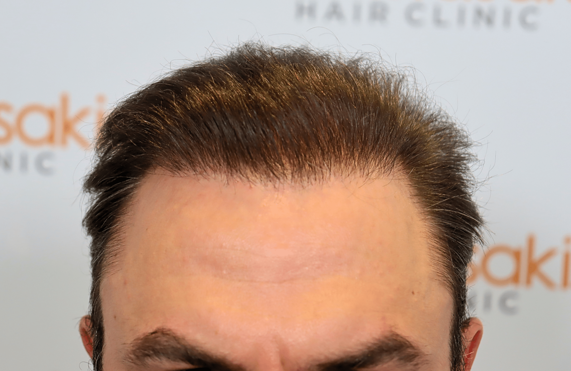 hair transplant result 5200 fus