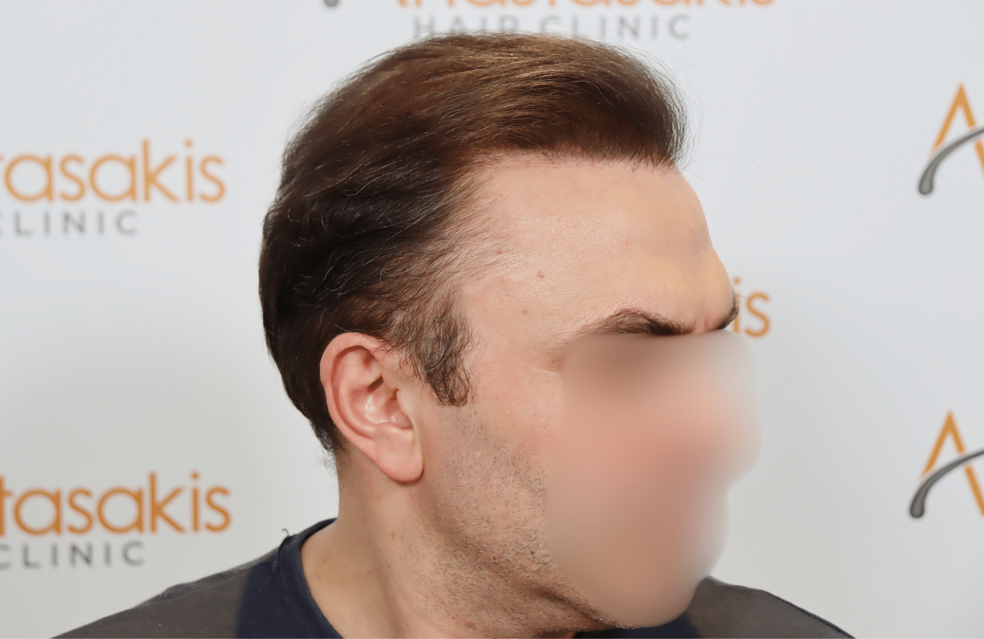 hair transplant result 5200 fus