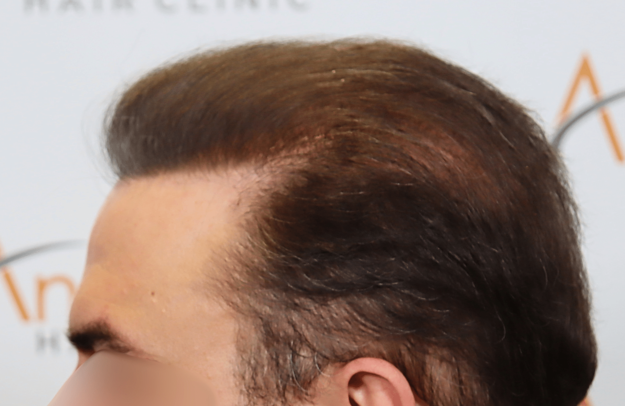 hair transplant result 5200 fus