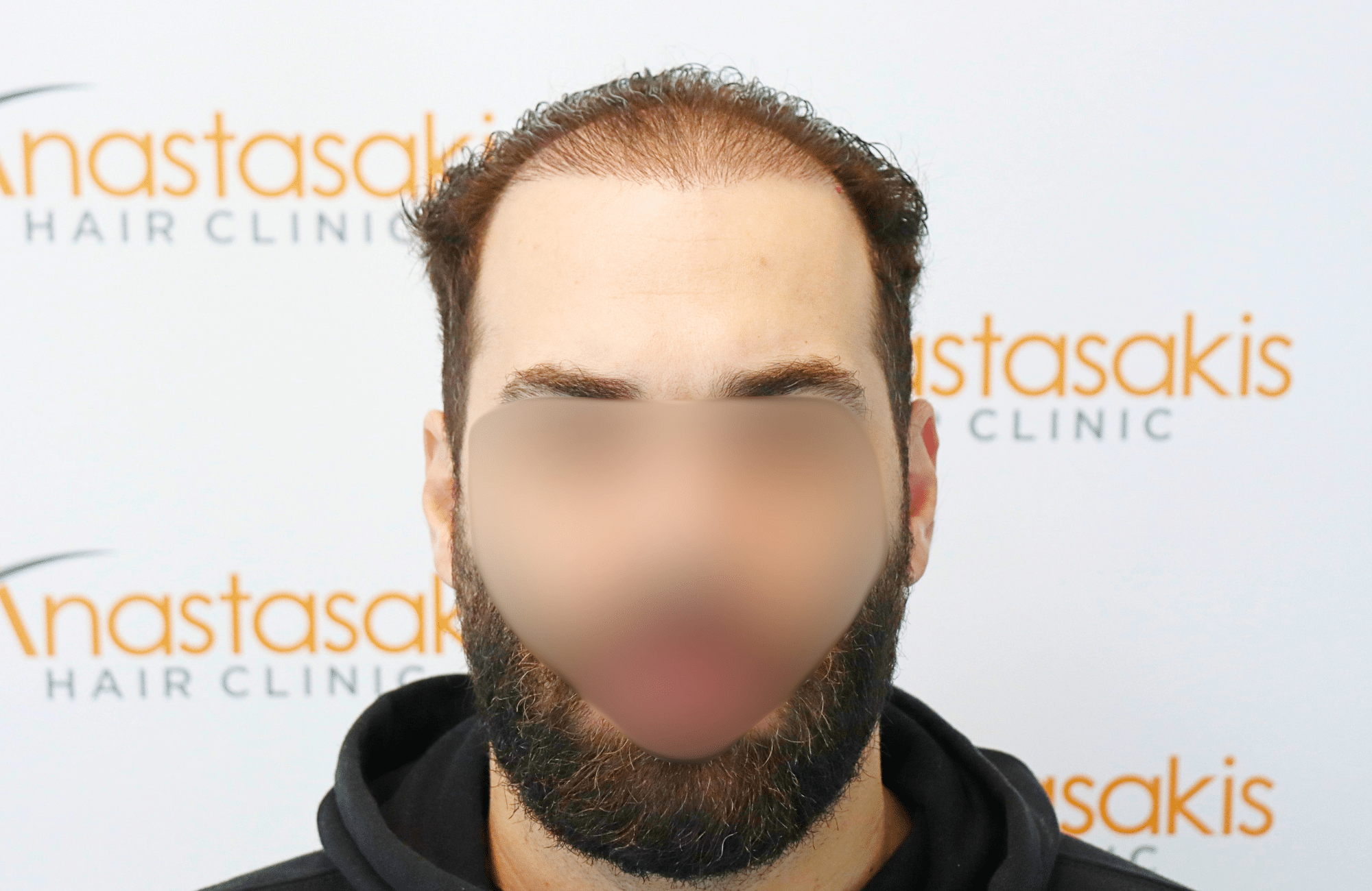 hair transplant result 2200 fus thick (1)