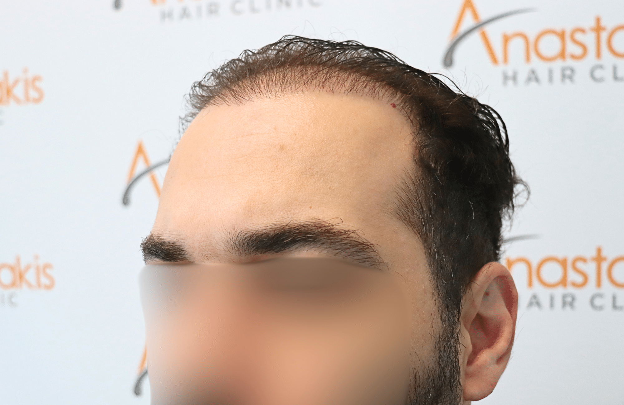 hair transplant result 2200 fus thick (5)