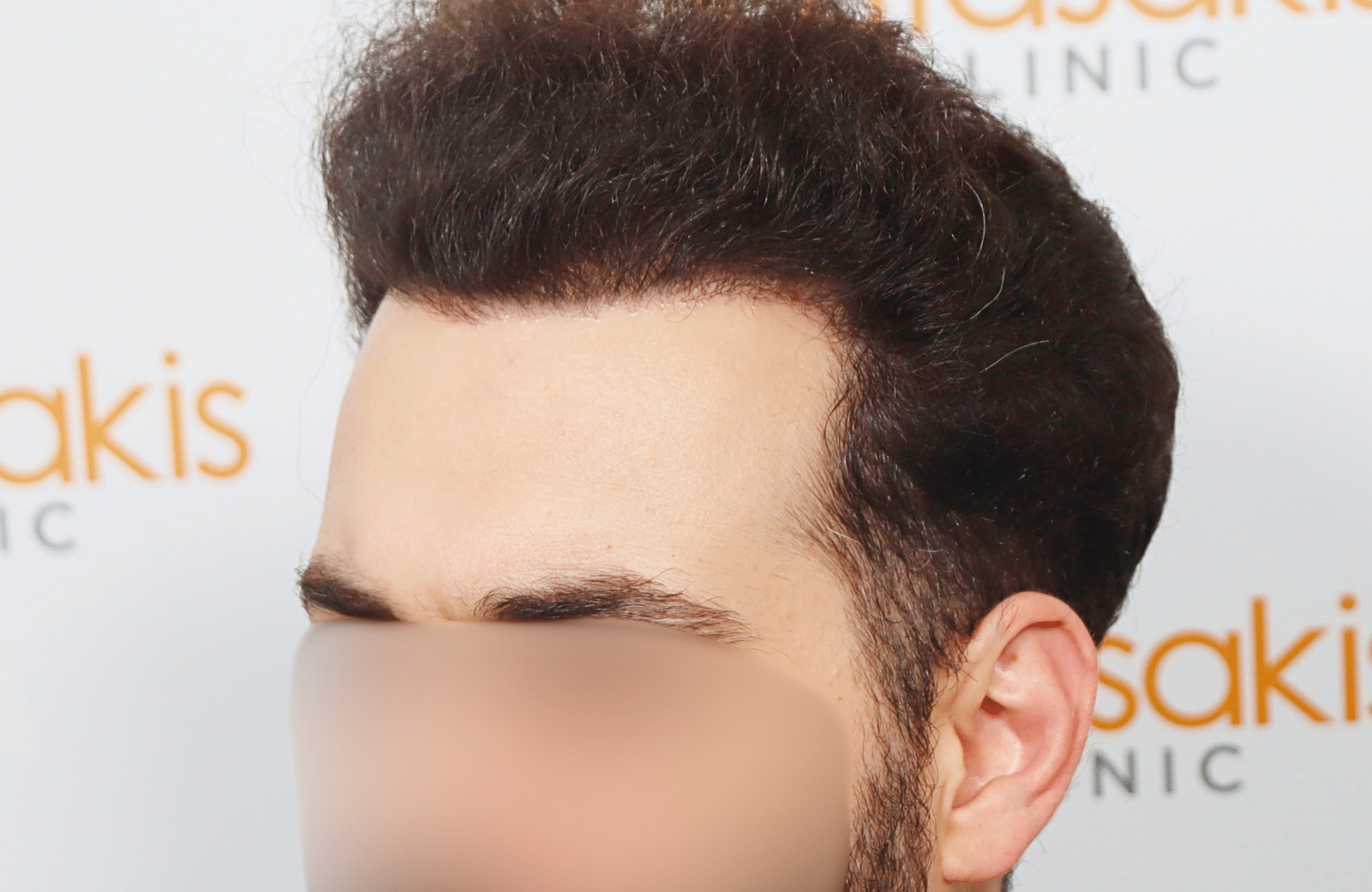 hair transplant result 2200 fus thick (6)