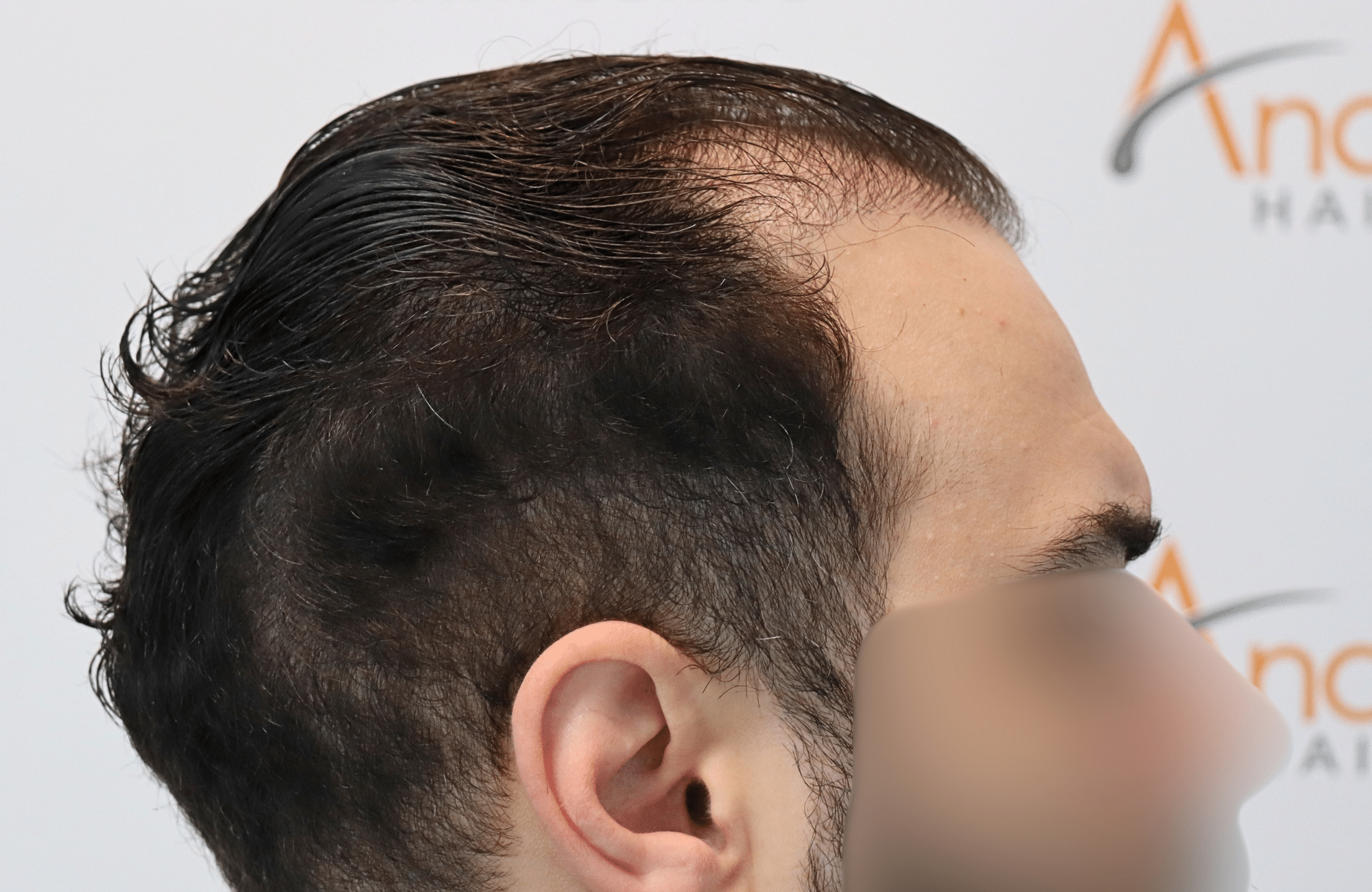 hair transplant result 2200 fus thick (7)
