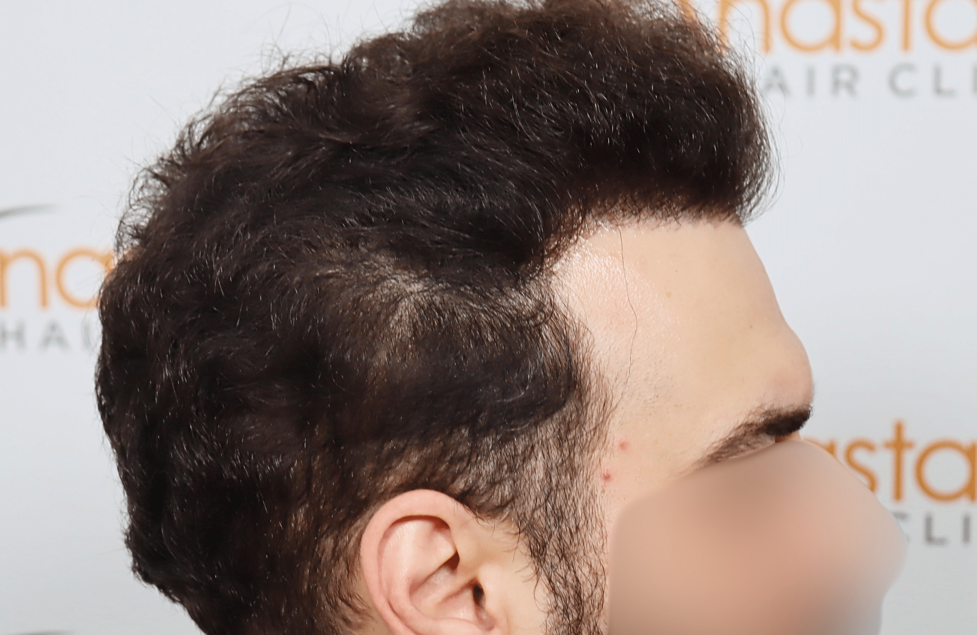 hair transplant result 2200 fus thick (8)