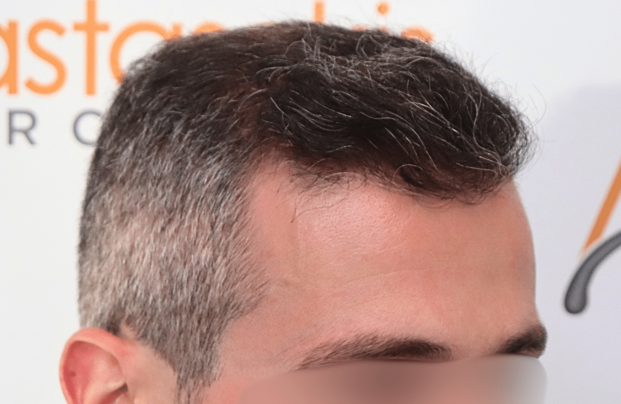 hair transplant result 2500 fus 40yo grey (3)