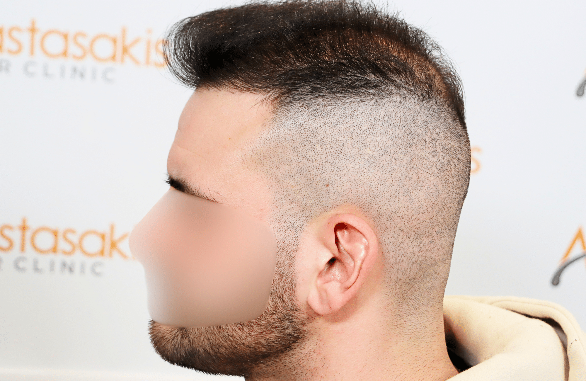 hair transplant result 2500 fus frontal (10)
