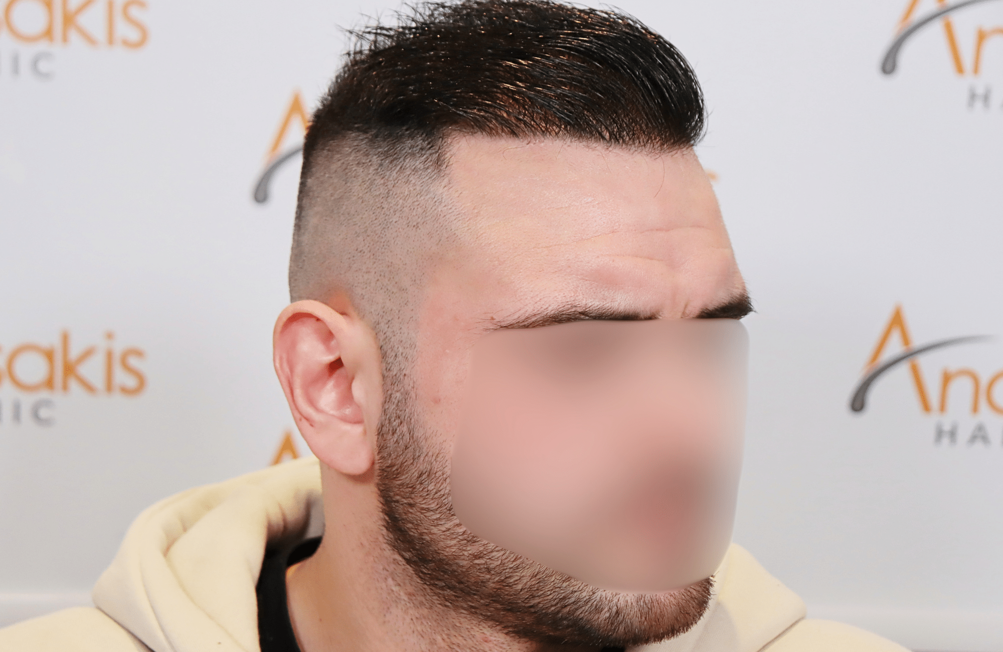 hair transplant result 2500 fus frontal (6)