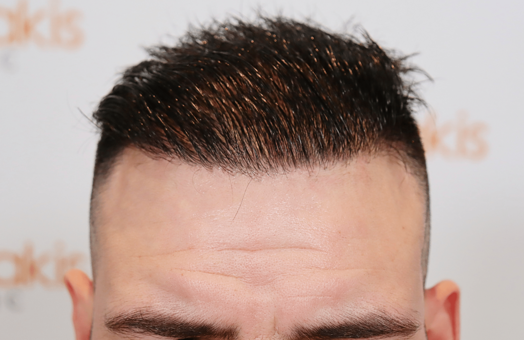 hair transplant result 2500 fus frontal (10)