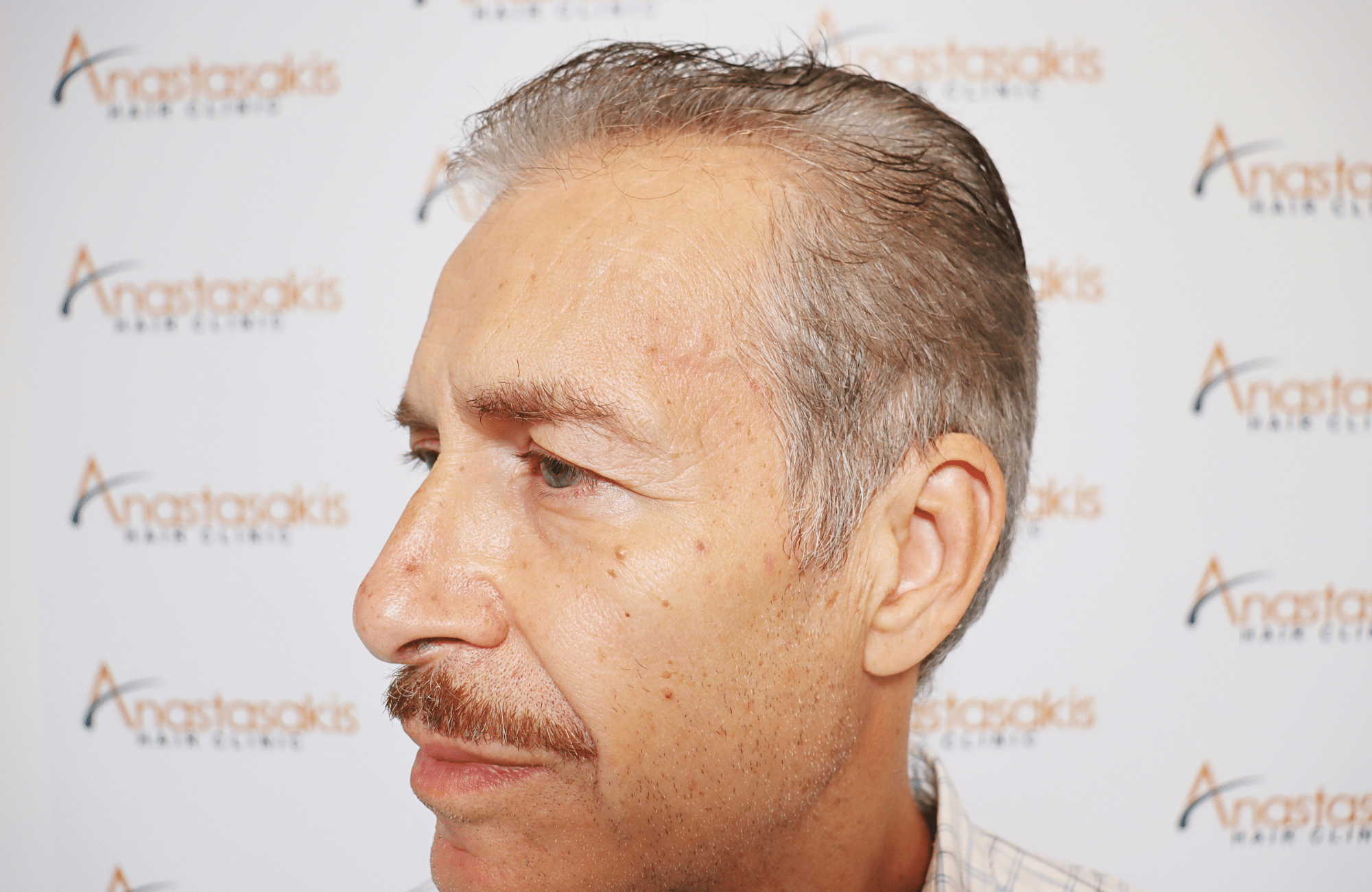 hair transplant result 2500 fus grey (11)