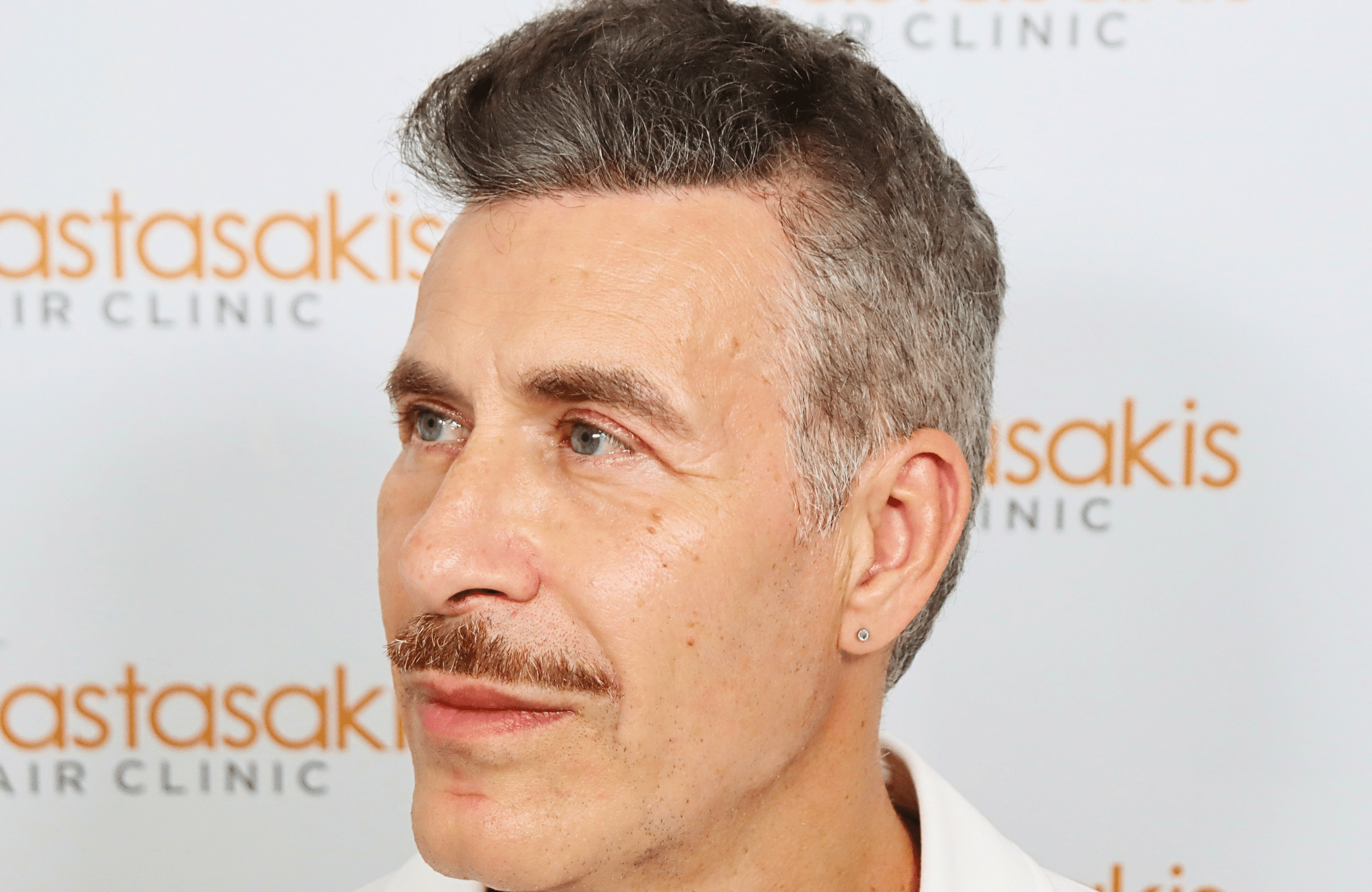 hair transplant result 2500 fus grey (12)