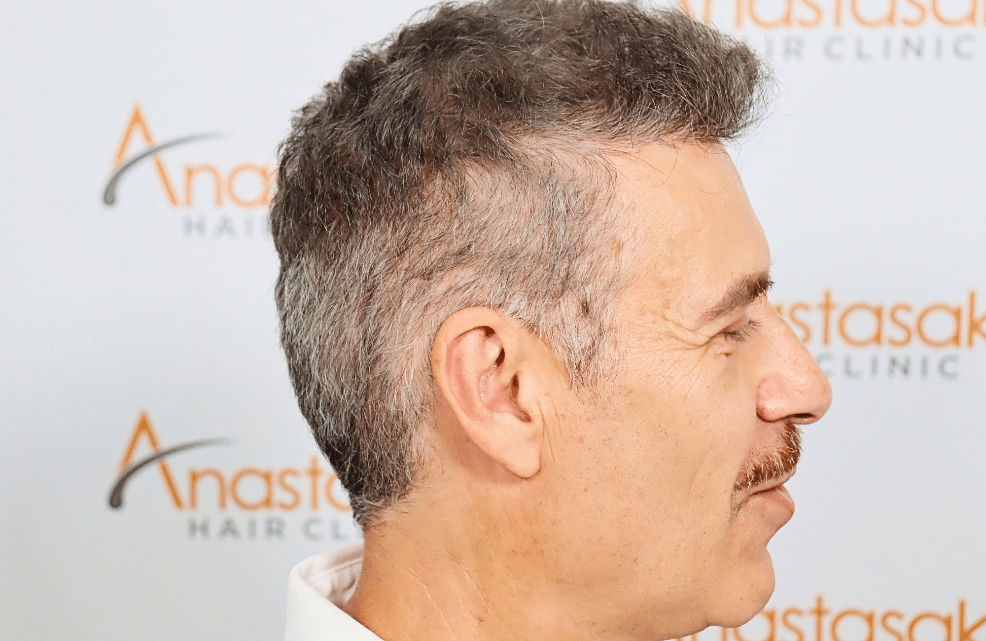 hair transplant result 2500 fus grey (14)