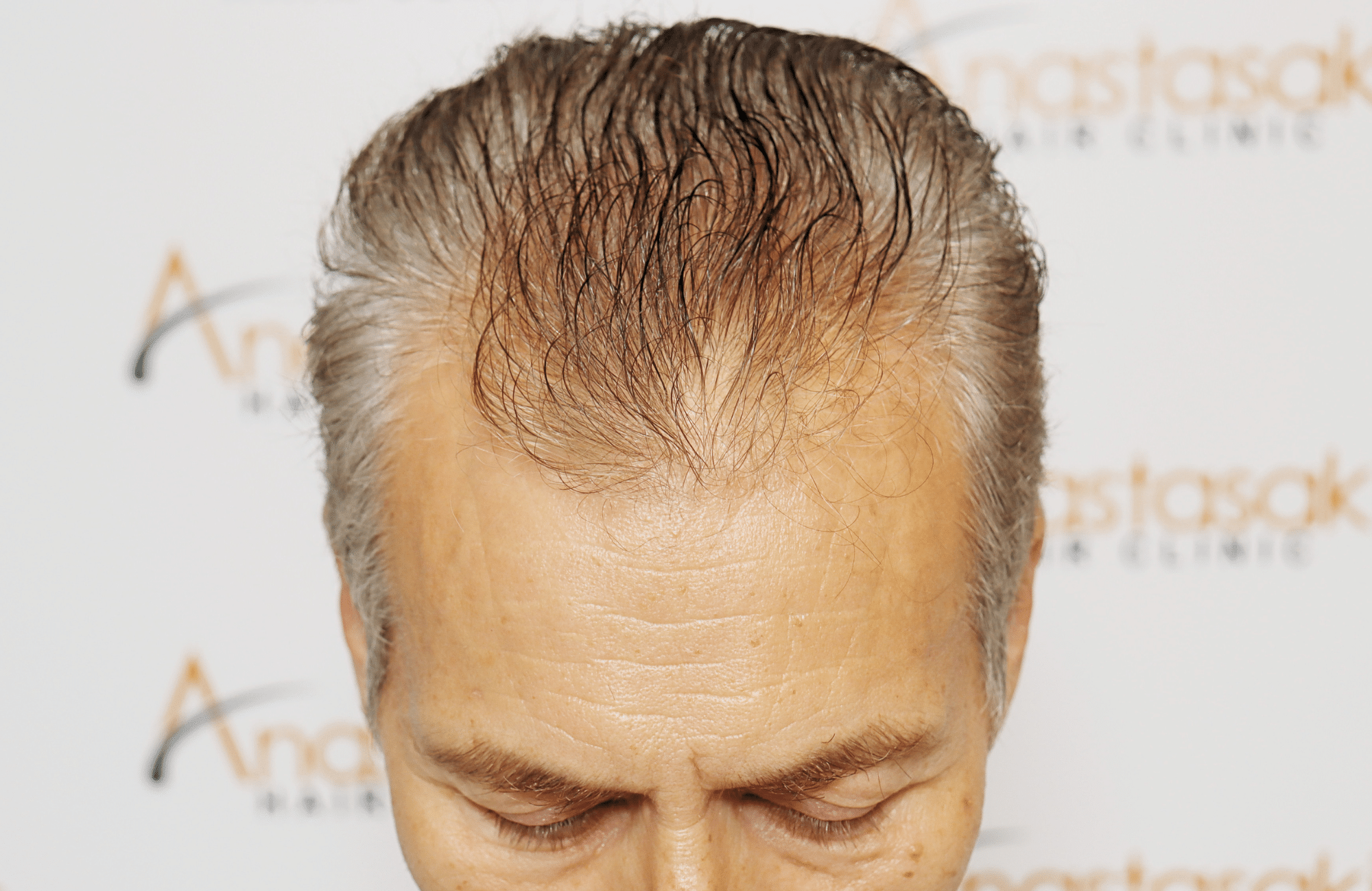 hair transplant result 2500 fus grey (17)