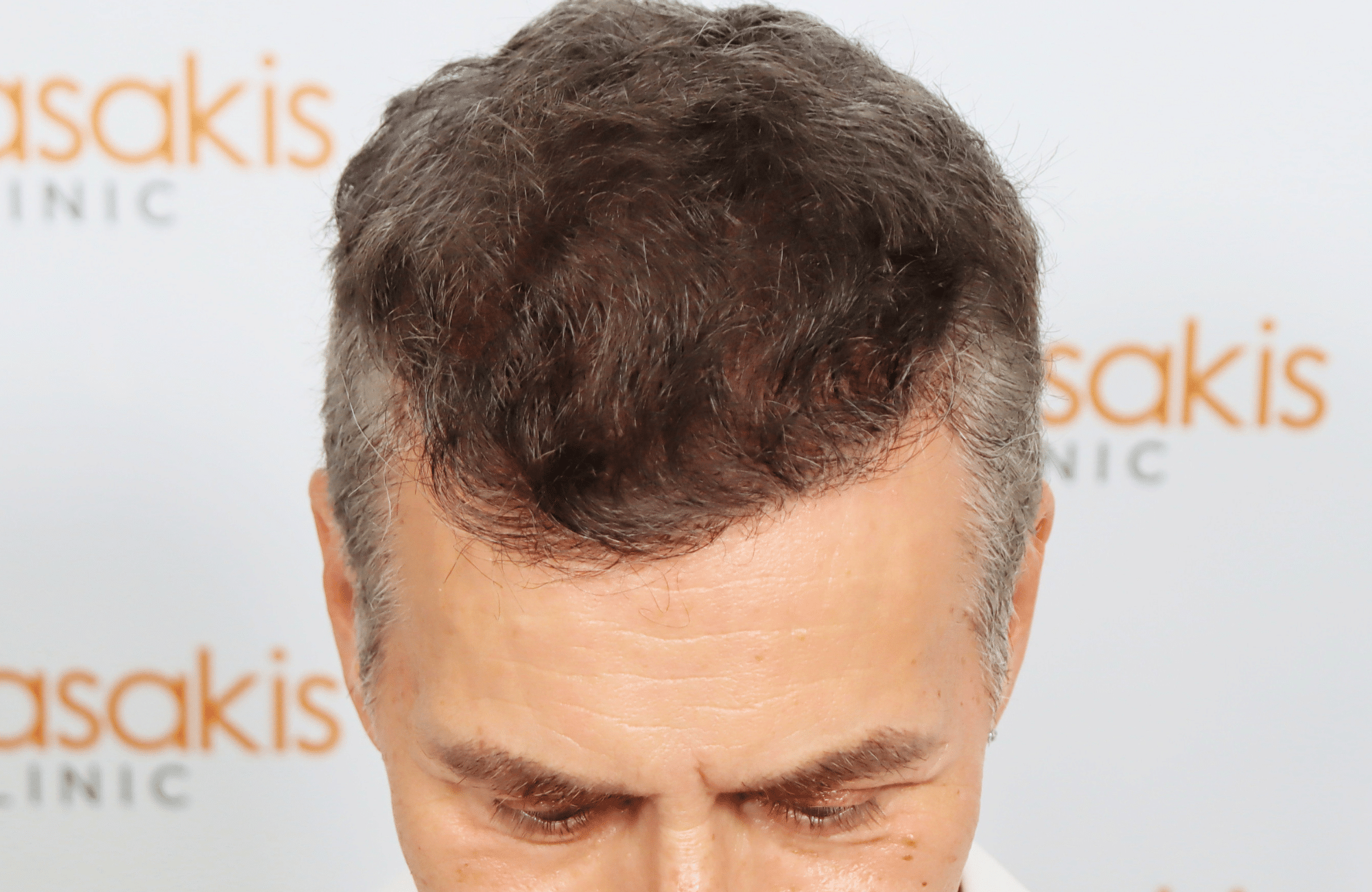hair transplant result 2500 fus grey (18)