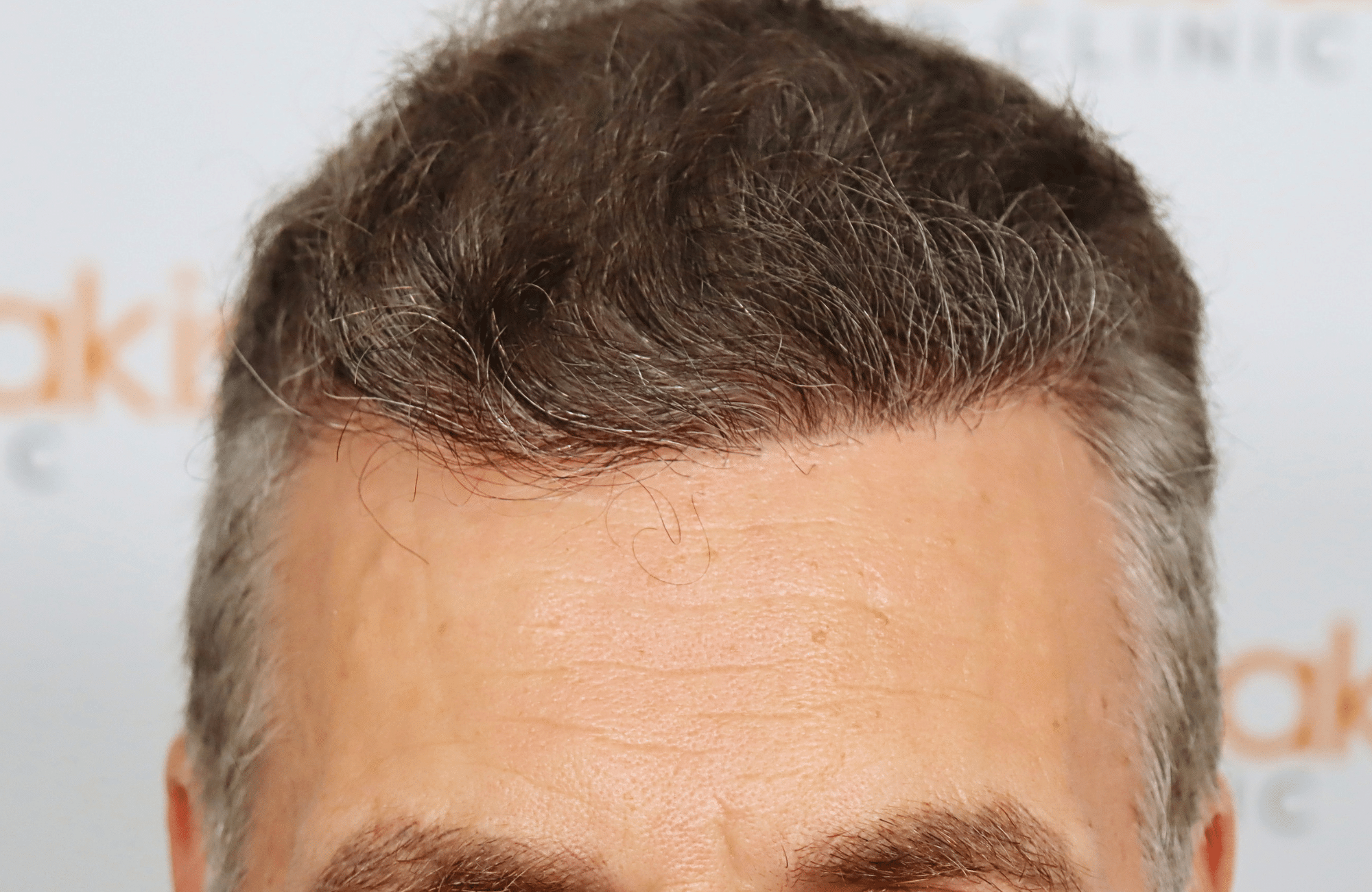 hair transplant result 2500 fus grey (20)