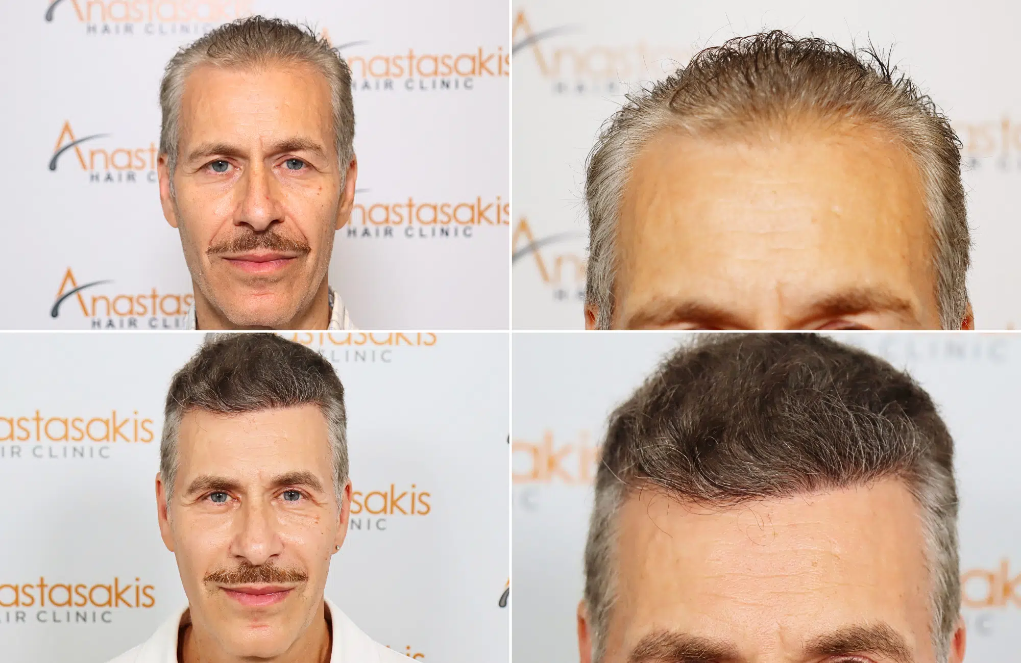 hair transplant result 2500 fus grey (5)